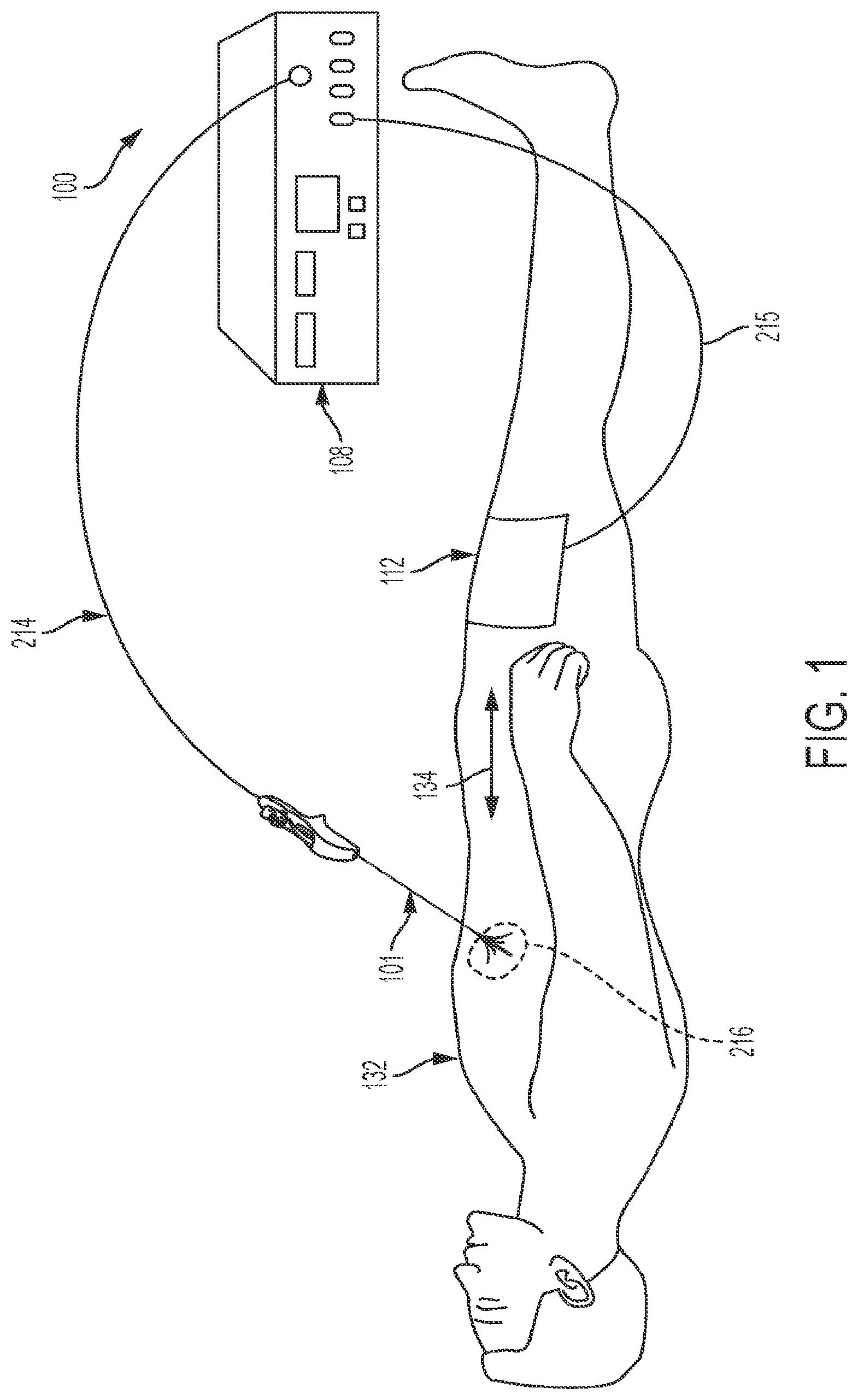 Patent US12303182 — Techniques for irreversible electroporation using a single-pole tine-style internal device communicating with an external surface electrode — Figure 1