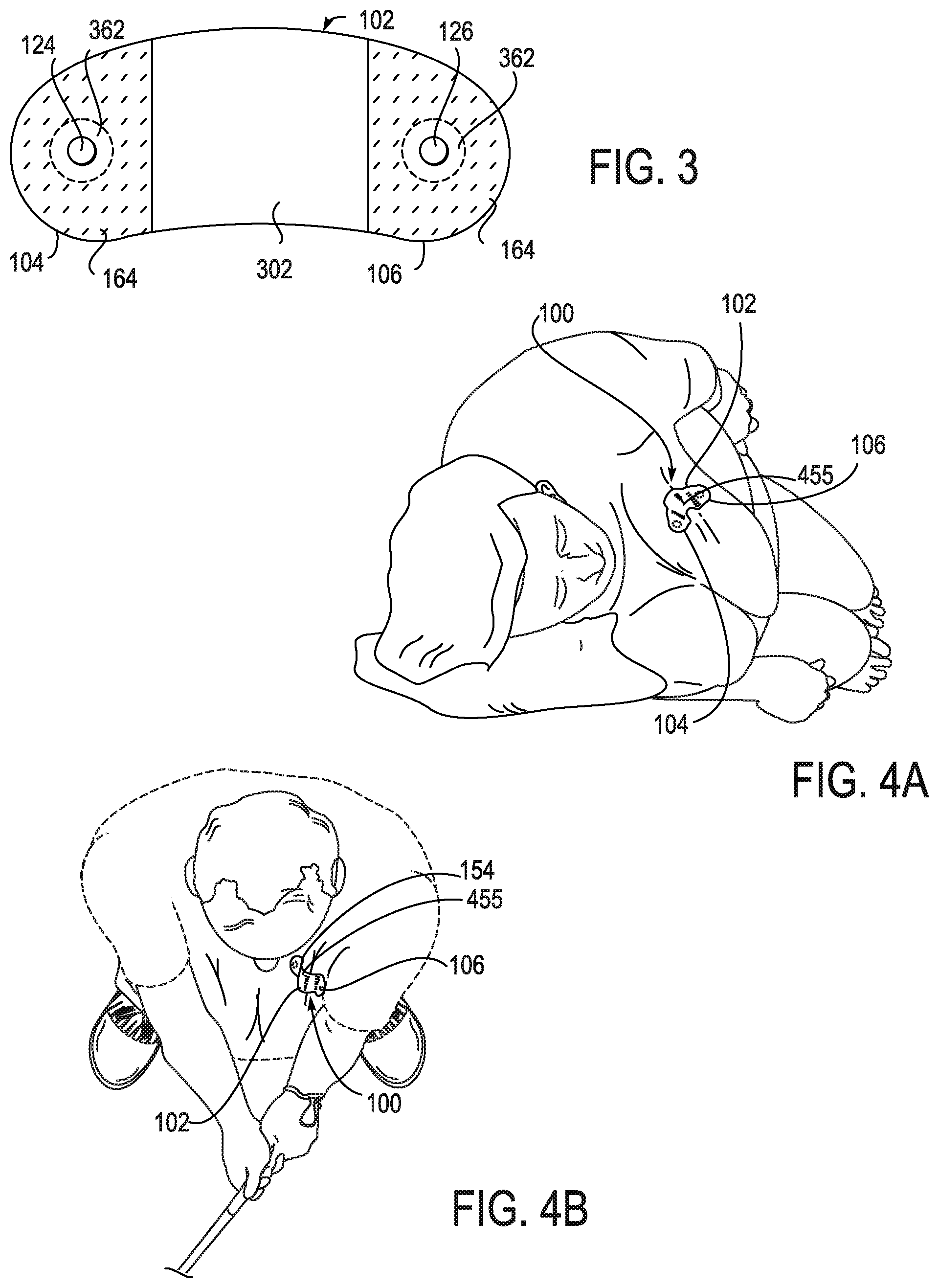 Patent US12303277 Figure 6 – Device features and design elements for long-term adhesion