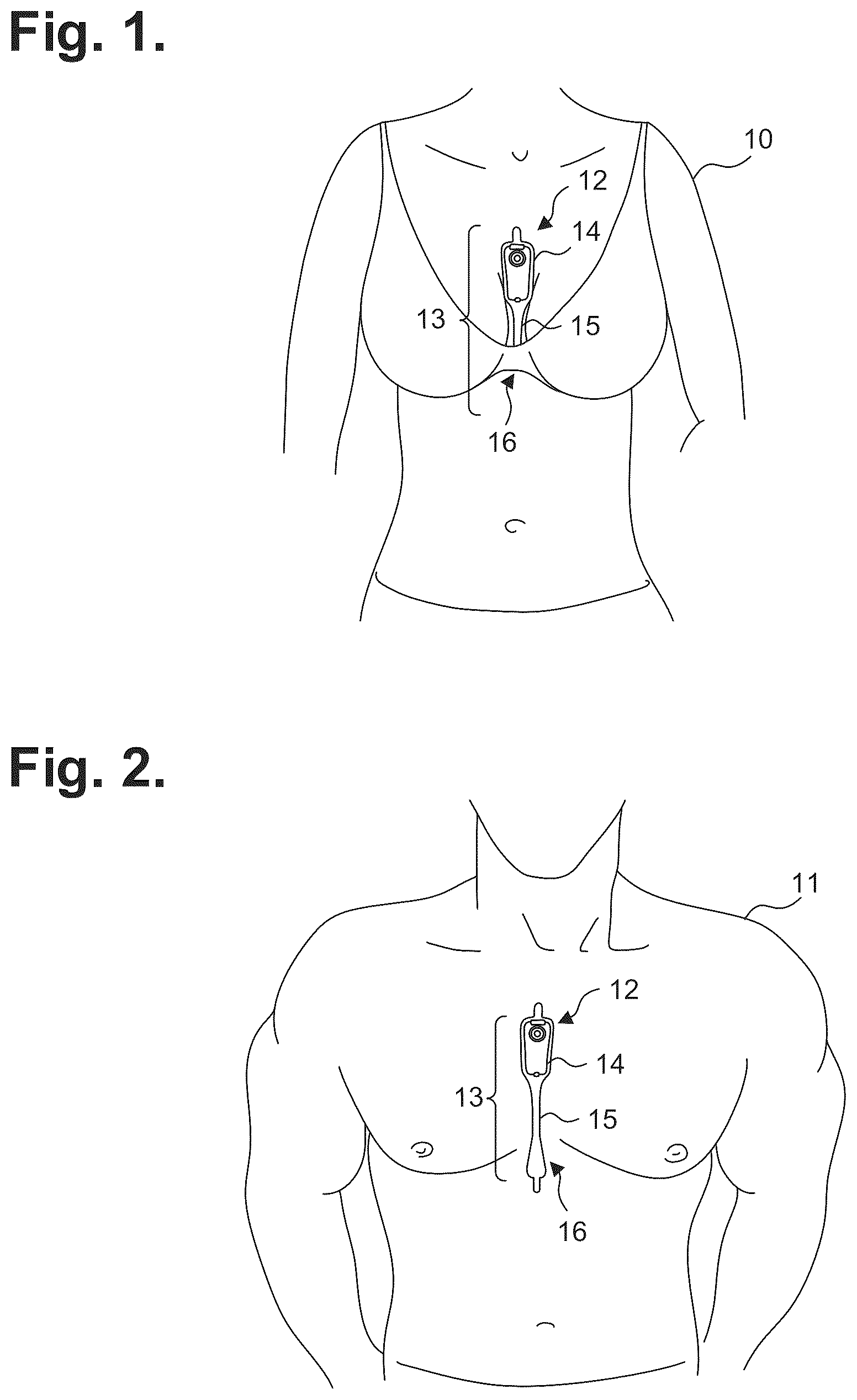 Patent US12303278 — Electrocardiography patch — Figure 1