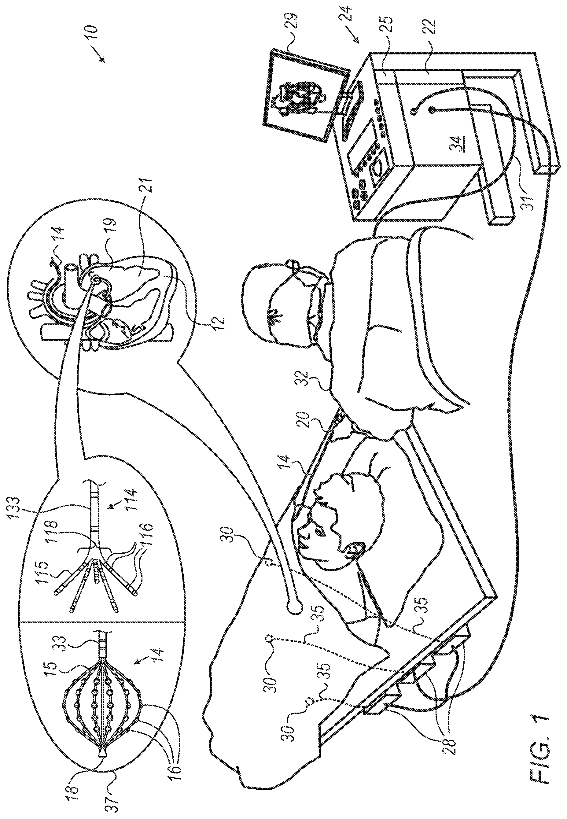 Patent US12303281 — Mapping resolution of electrophysiological (EP) wave propagating on the surface of patient heart — Figure 1