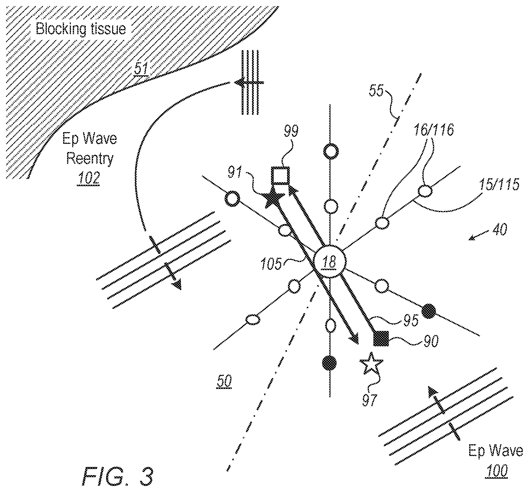 Patent US12303281 Figure 3 – Mapping resolution of electrophysiological (EP) wave propagating on the surface of patient heart