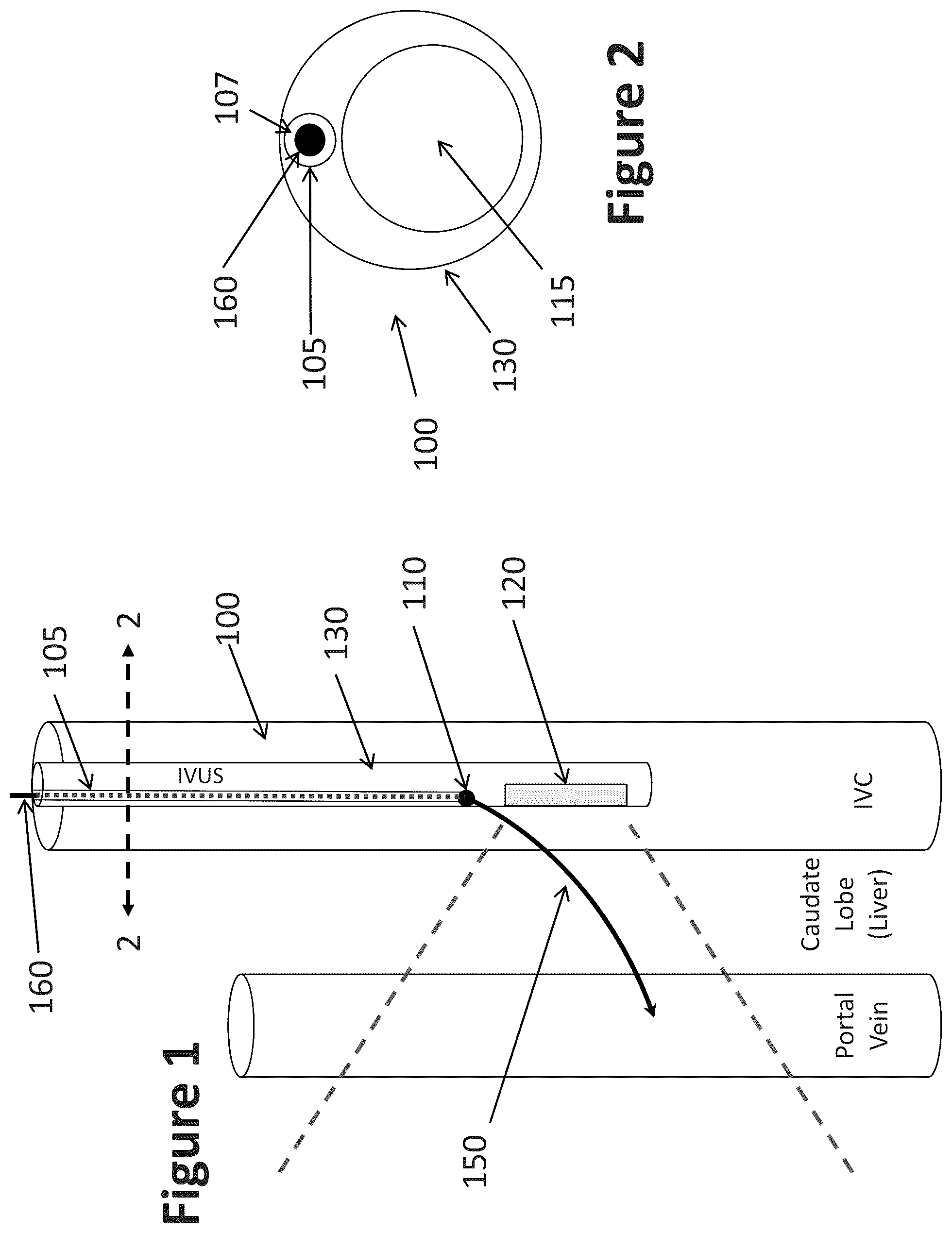 Patent US12303319 — Intravascular ultrasound needle guide — Figure 1