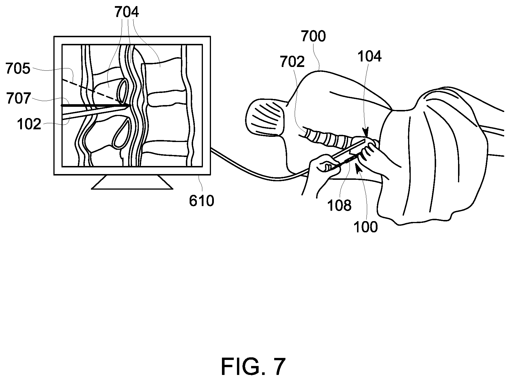 Patent US12303320 Figure 9 – Ultrasound probe with an integrated needle assembly and a computer program product, a method and a system for providing a path for inserting a needle of the ultrasound probe