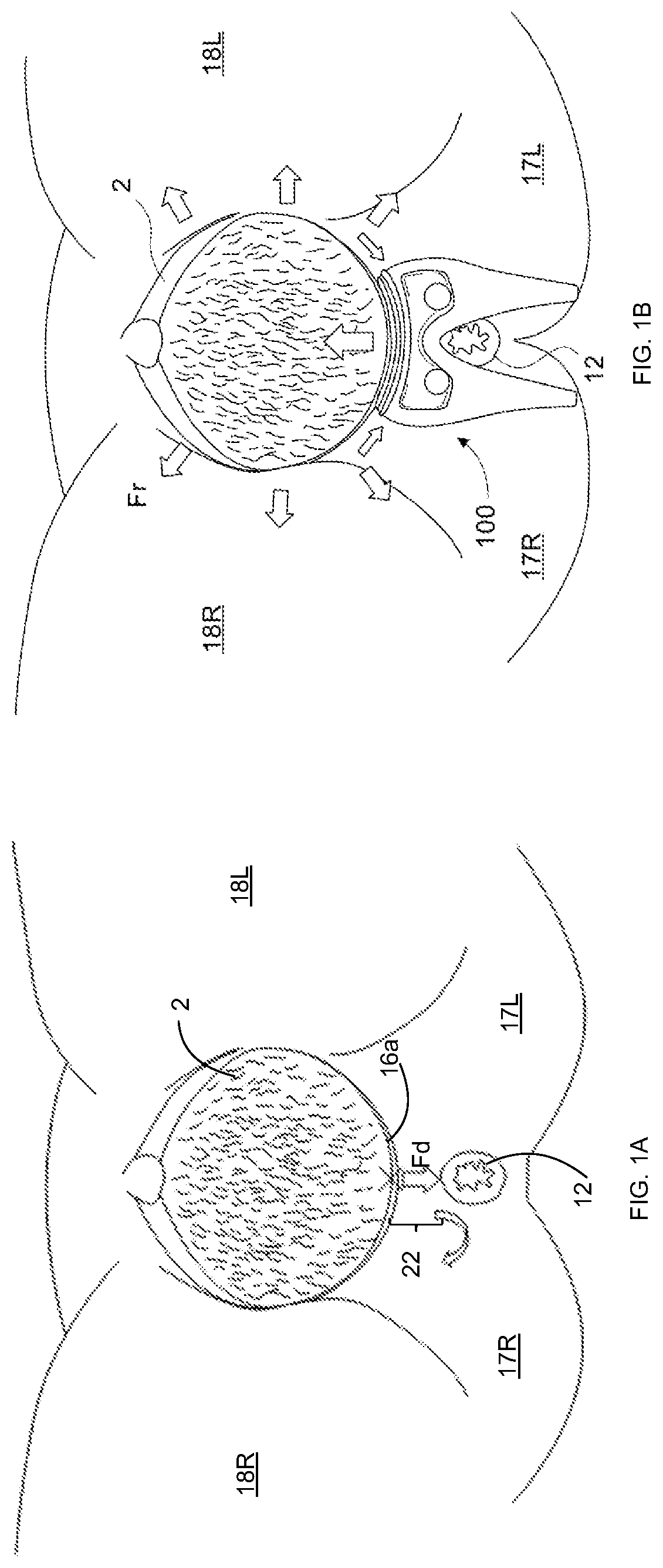 Patent US12303337 — Perineal protection device, system and method — Figure 1