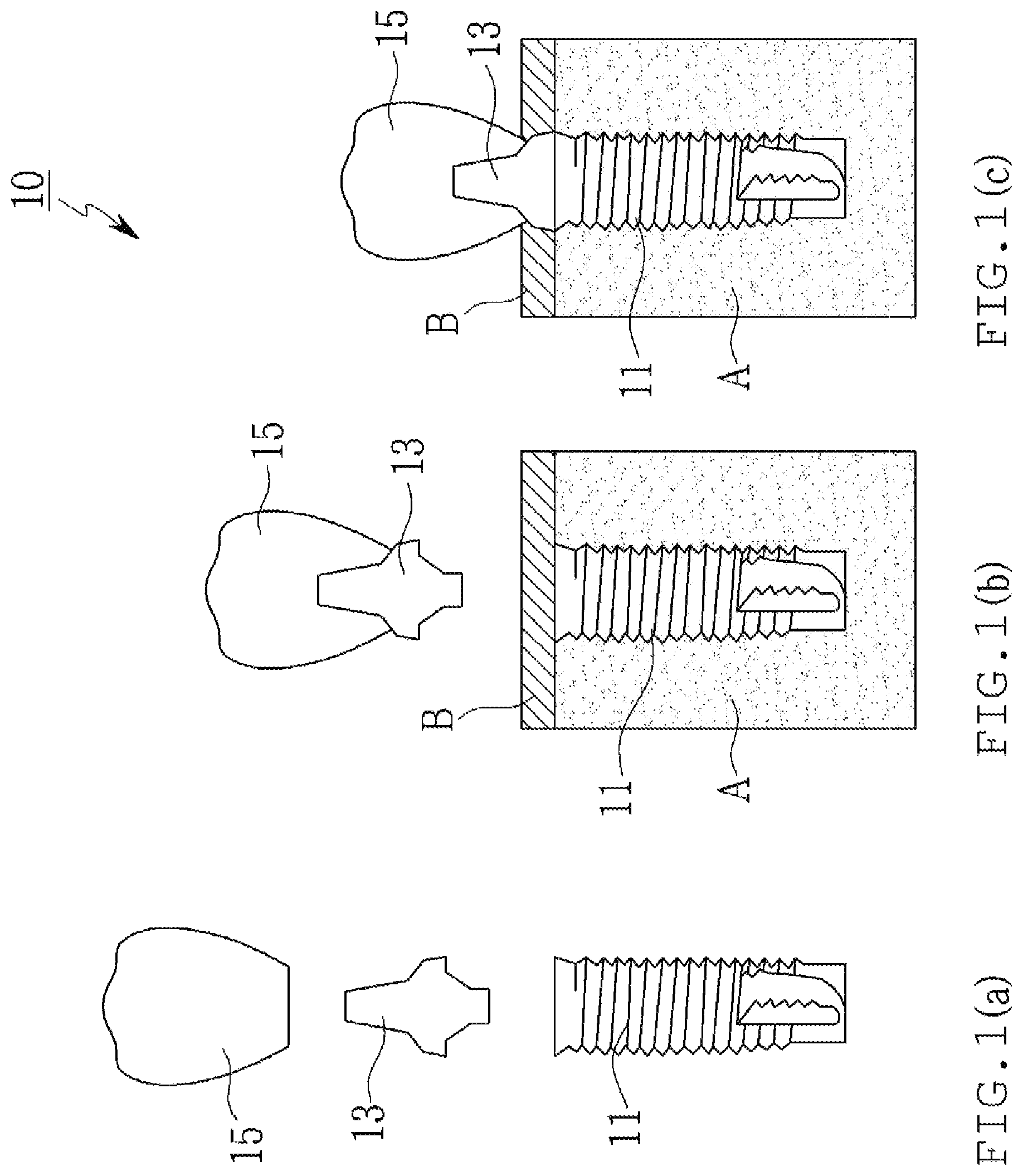Patent US12303350 — Lateral wall supported implant system with supporting screw surgical guide — Figure 1