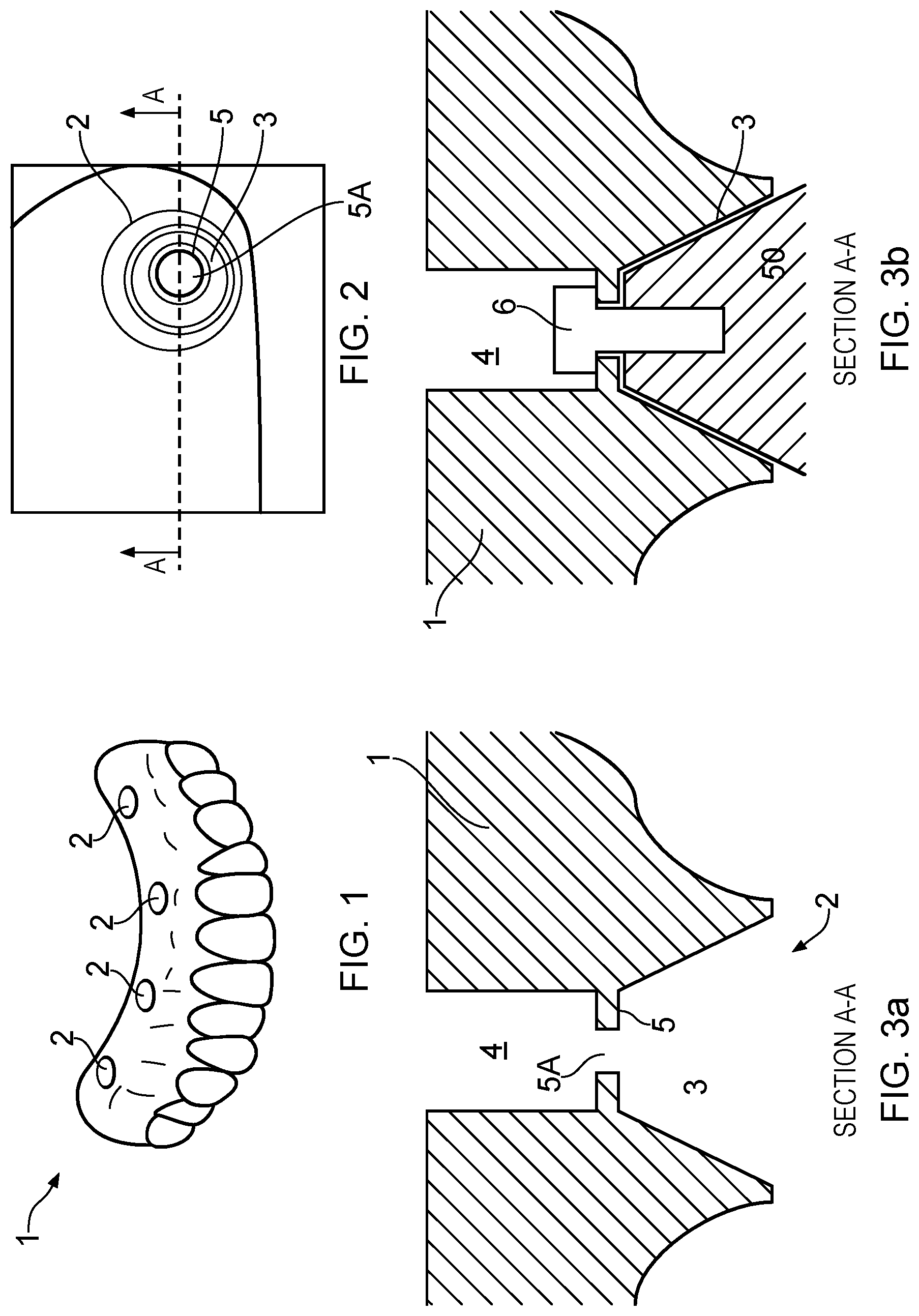 Patent US12303351 — Dental prosthesis — Figure 1