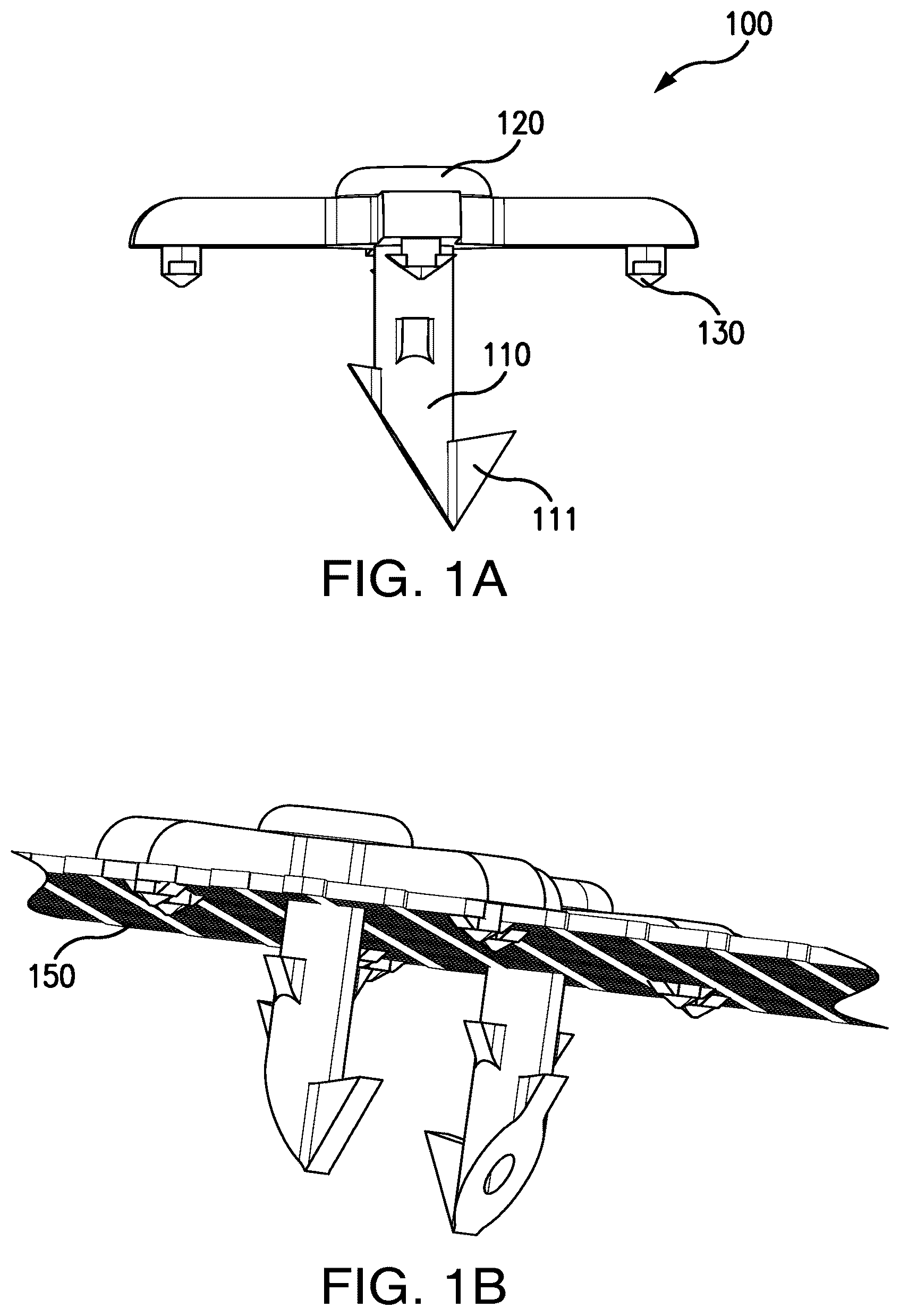 Patent US12303373 Figure 1 – Systems and methods for mesh augmentation and prevention of incisional hernia