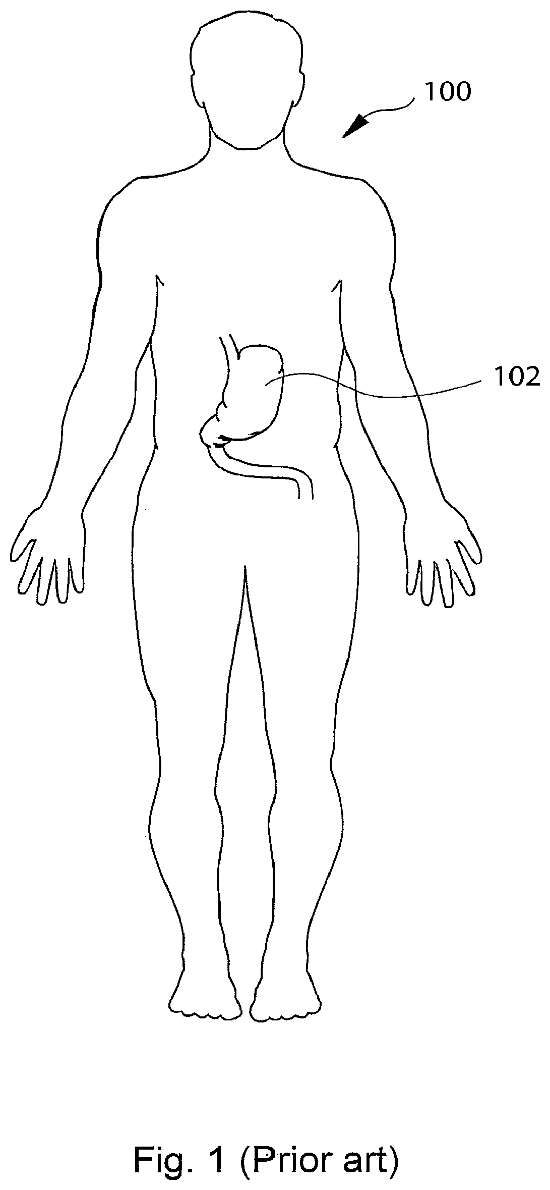 Patent US12303375 — Artificial stomach — Figure 1