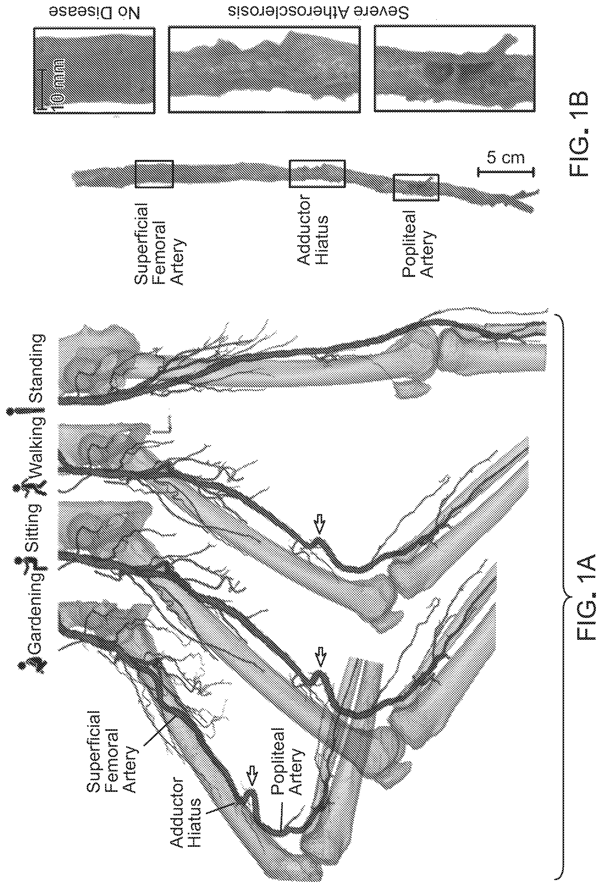 Patent US12303376 — Bypass graft — Figure 1
