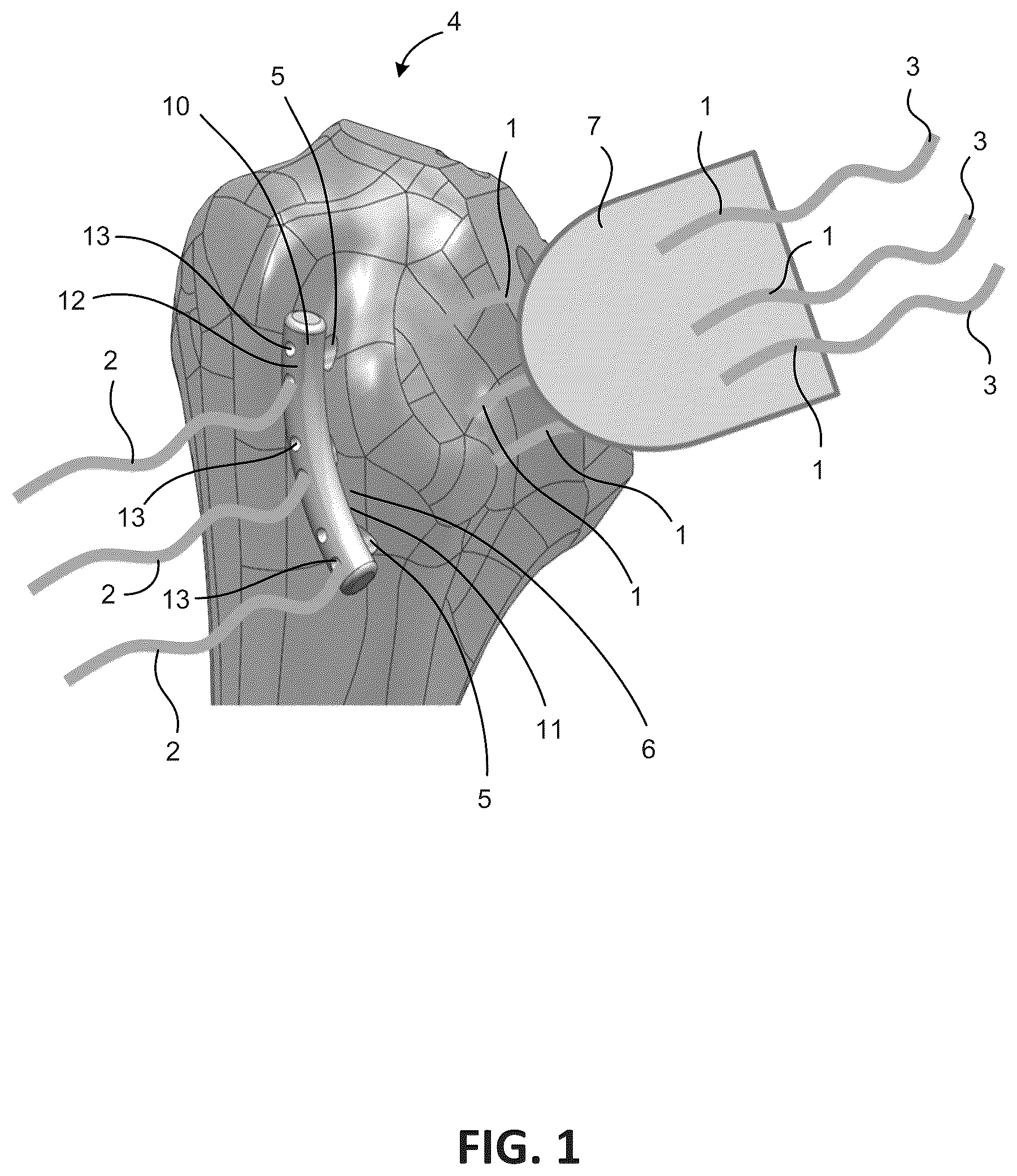 Patent US12303378 — Tendon repair system — Figure 1