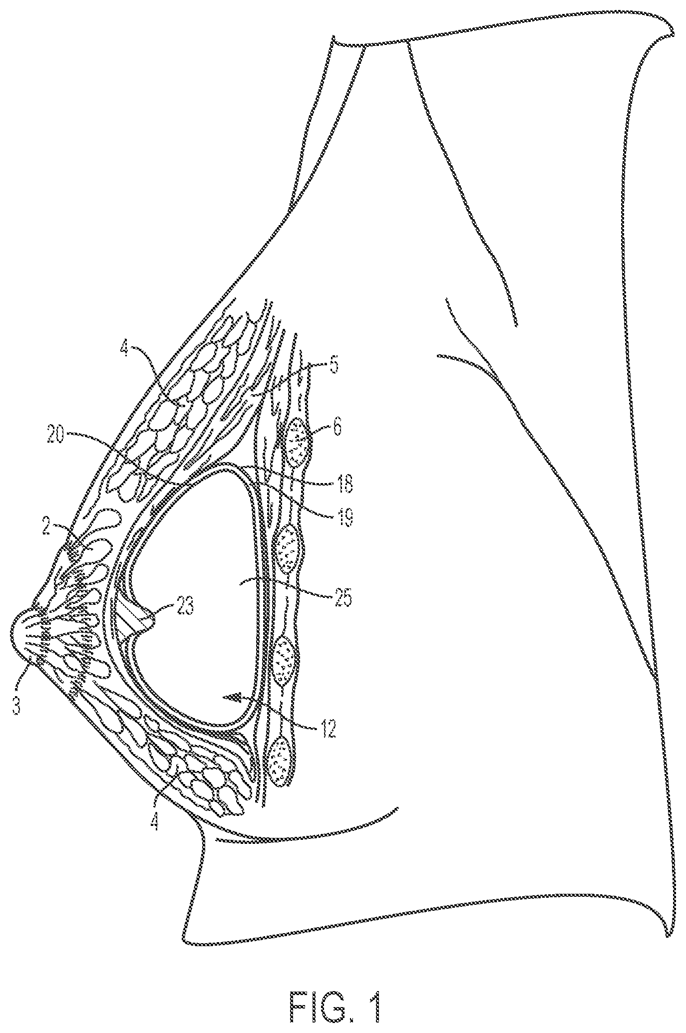 Patent US12303379 Figure 1 – Implant with elastomeric membrane and methods of fabrication thereof