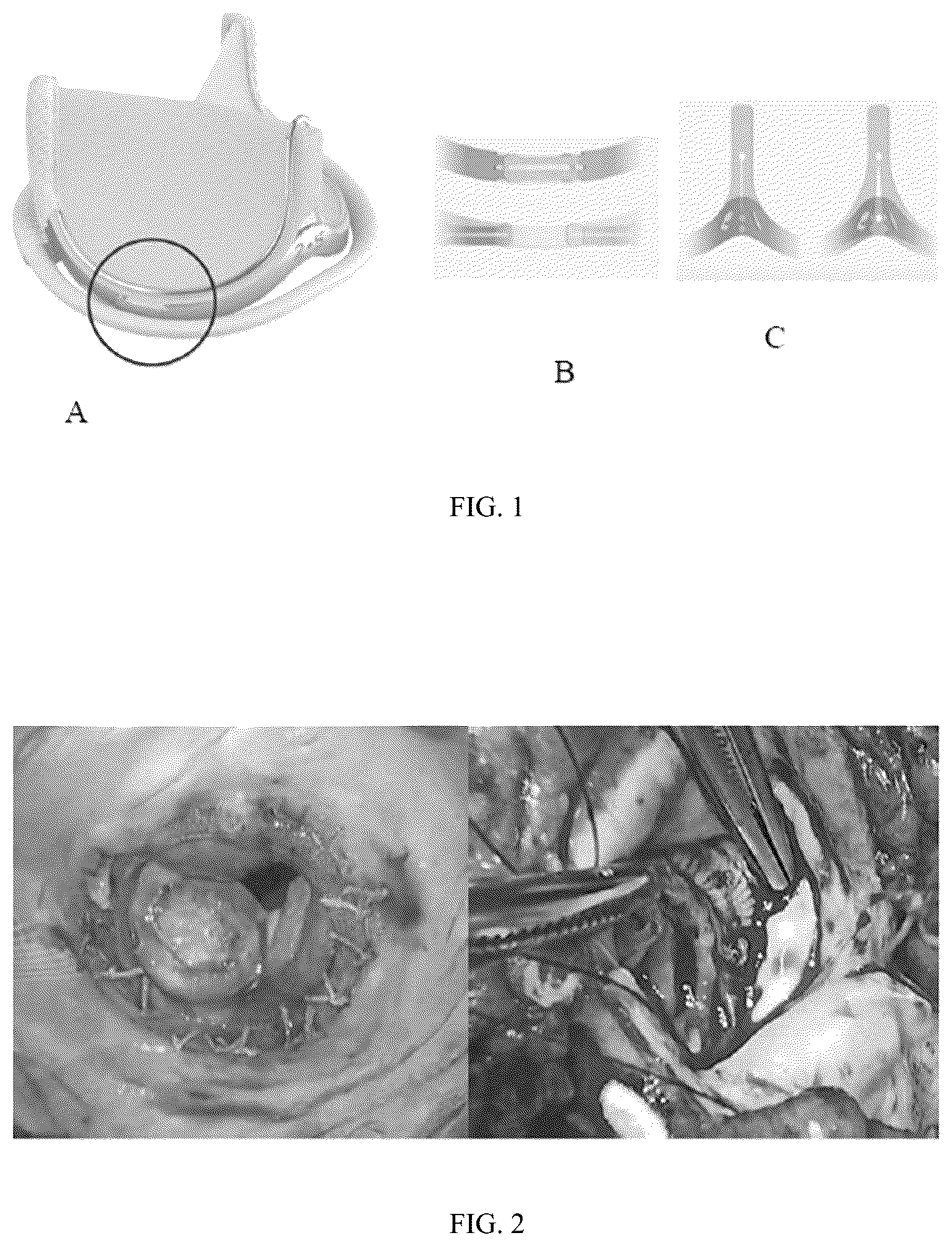 Patent US12303383 — One-way limiting expandable artificial biological heart valve — Figure 1