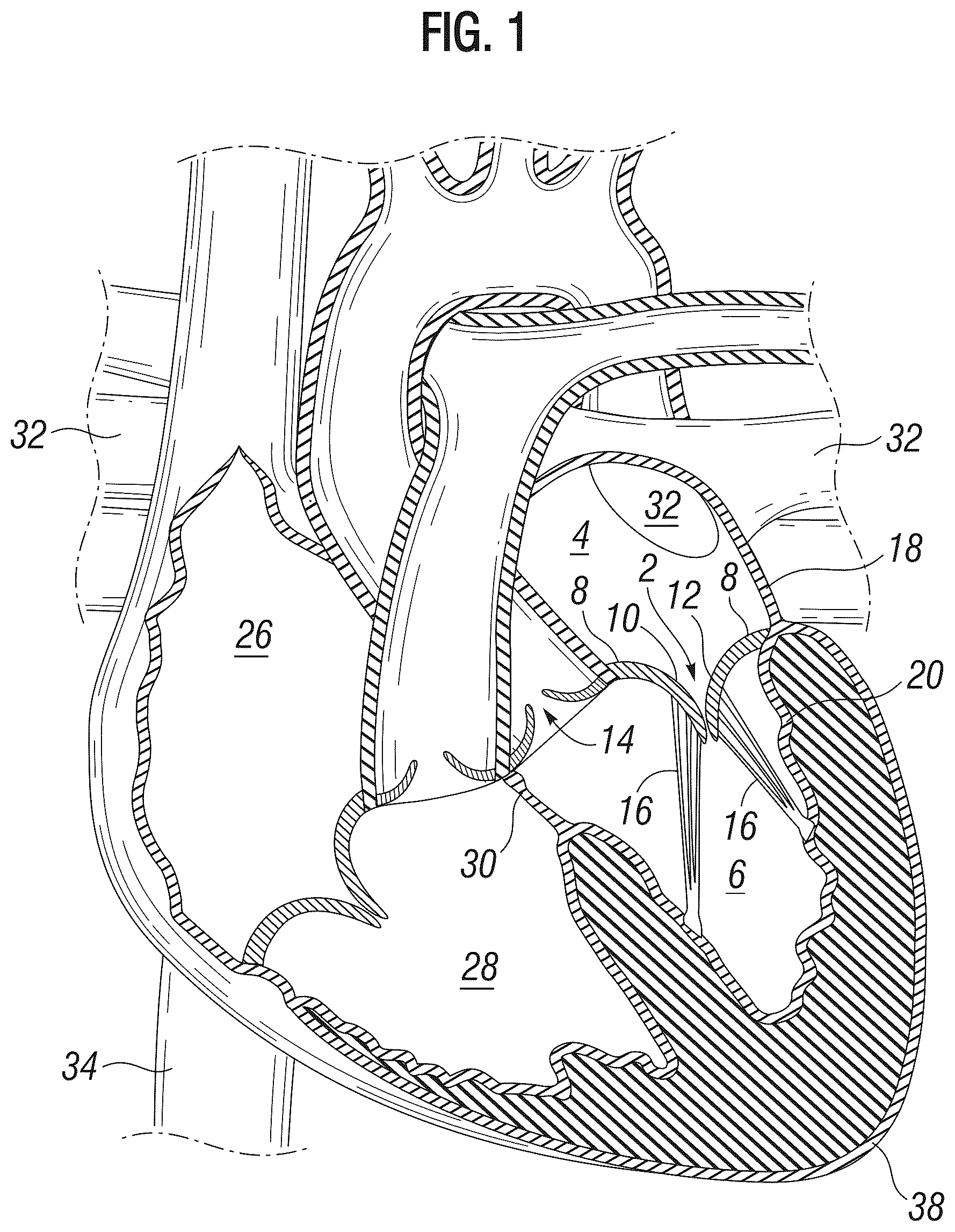 Patent US12303385 Figure 1 – Method of implanting a spacer body in a mitral valve