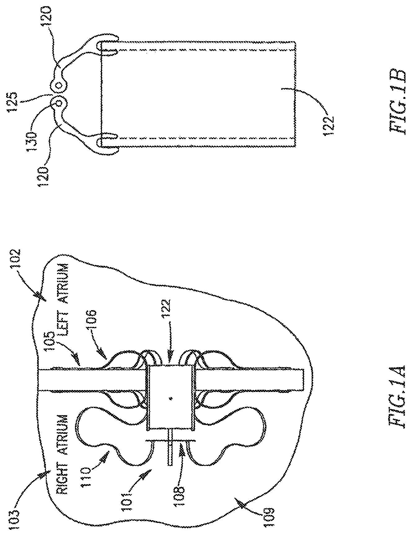 Patent US12303390 — Device and method for controlling in-vivo pressure — Figure 1