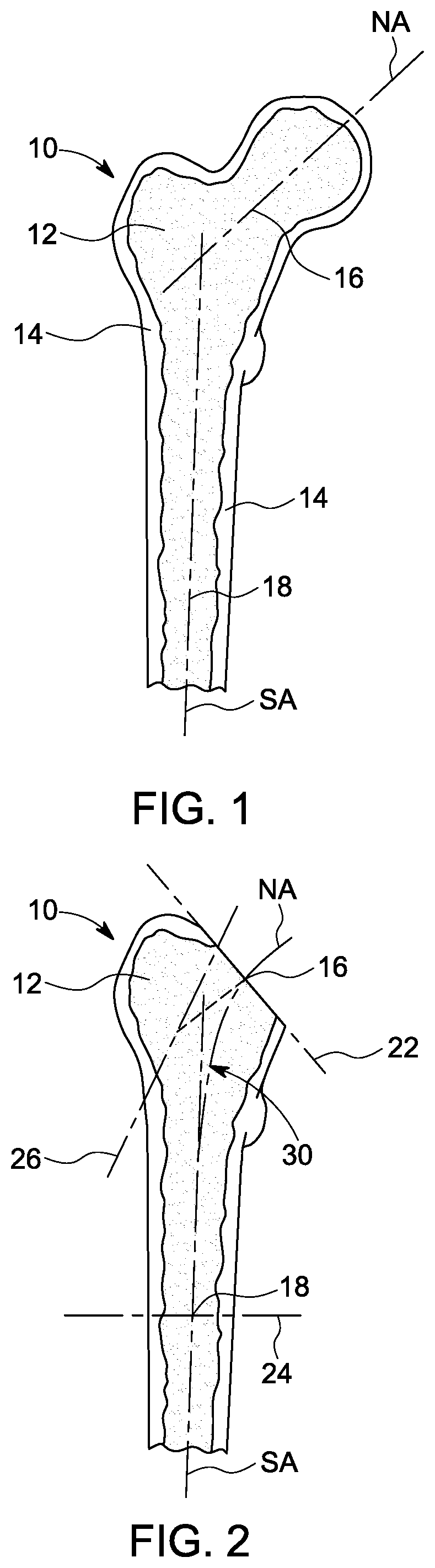 Patent US12303393 Figure 1 – Custom hip design and insertability analysis
