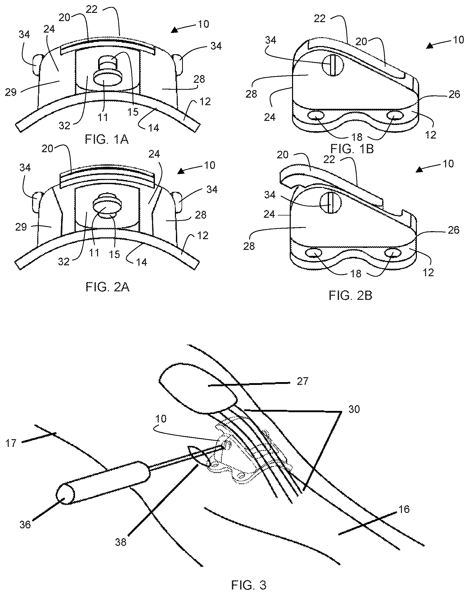 Patent US12303396 Figure 1 – Adjustable patellar tendon realignment implant