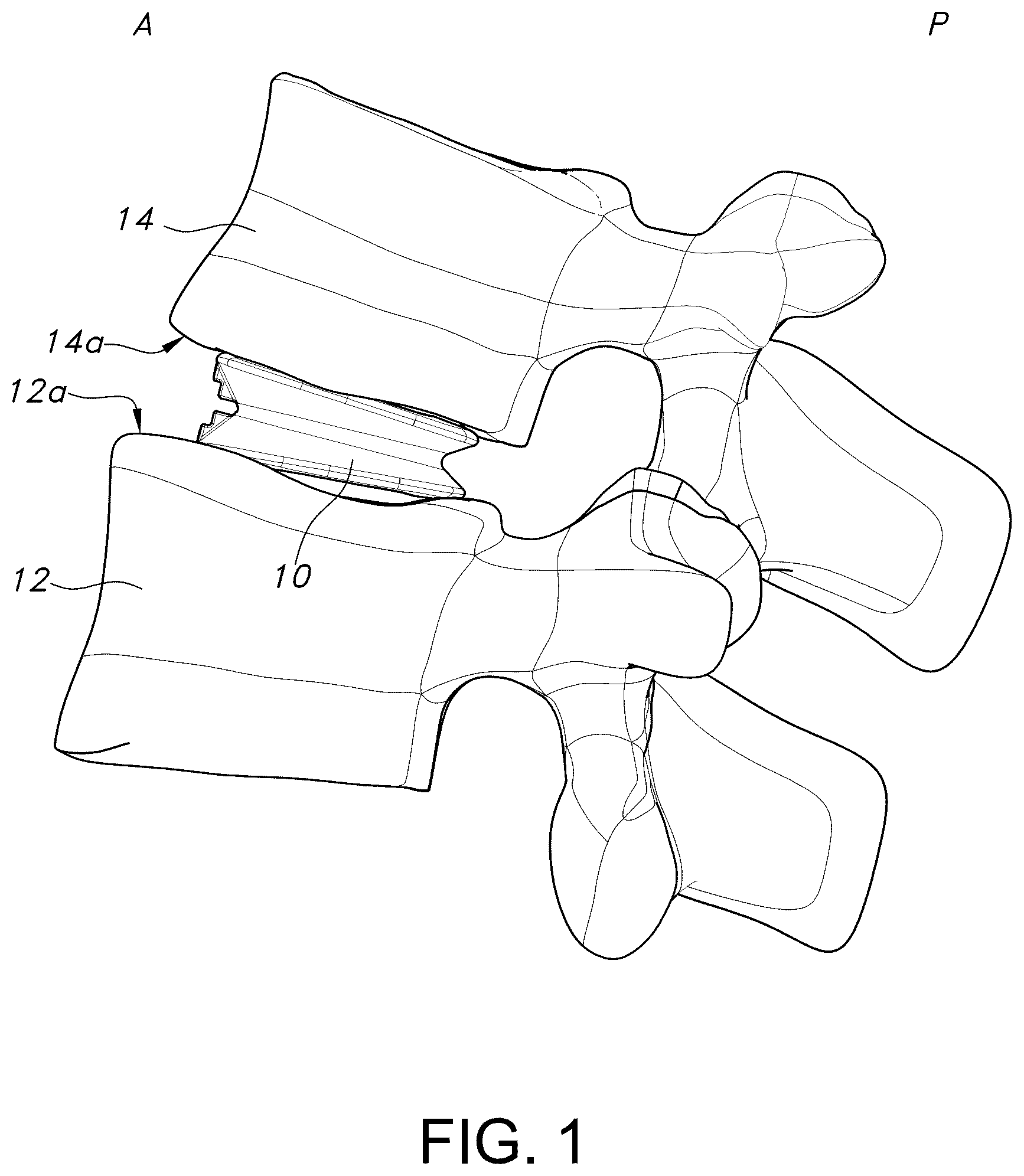 Patent US12303403 — Spinal interbody fusion device — Figure 1