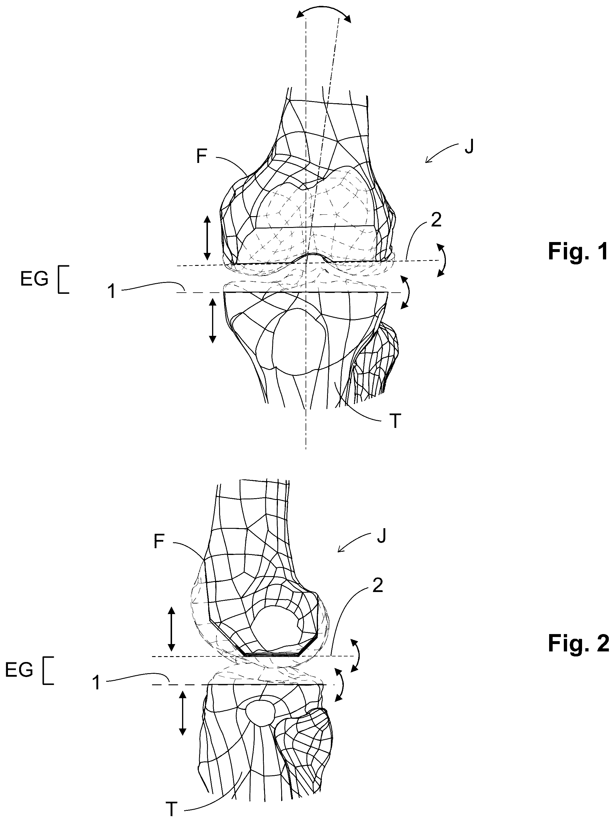 Patent US12303405 — Knee arthroplasty method — Figure 1