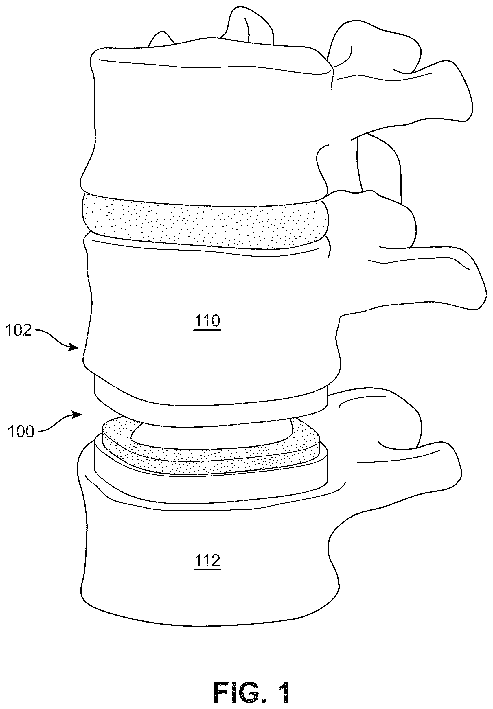 Patent US12303406 — Method of implanting an artificial disc replacement device — Figure 1