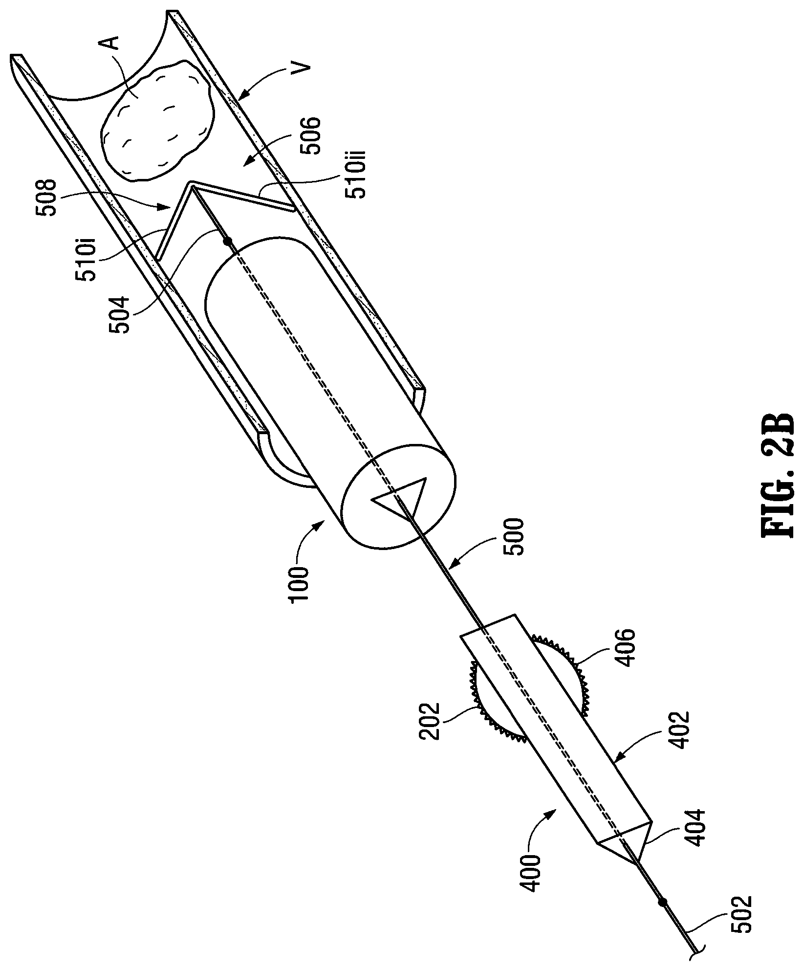 Patent US12303412 Figure 3 – Orientable implantable device and method