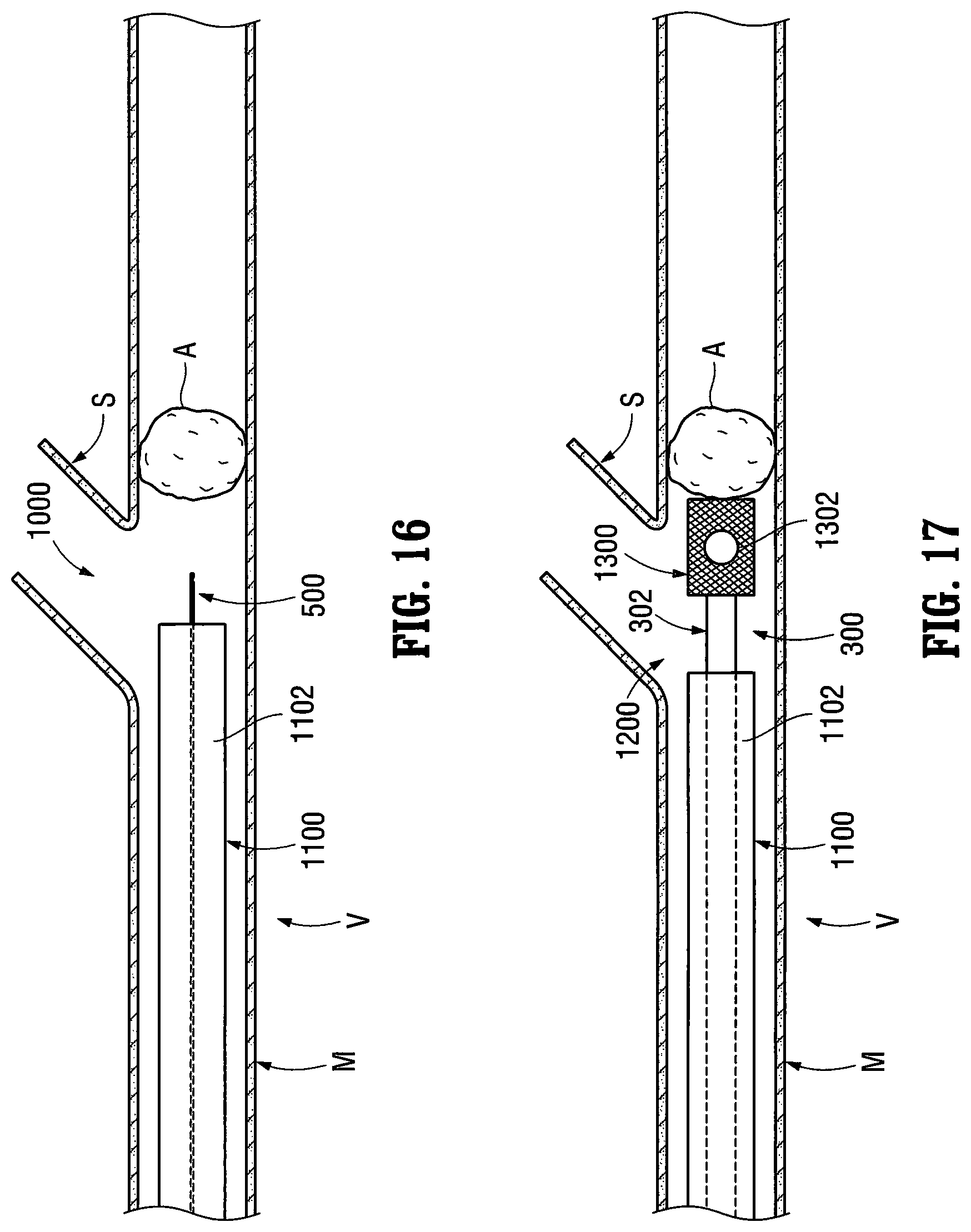 Patent US12303412 Figure 11 – Orientable implantable device and method