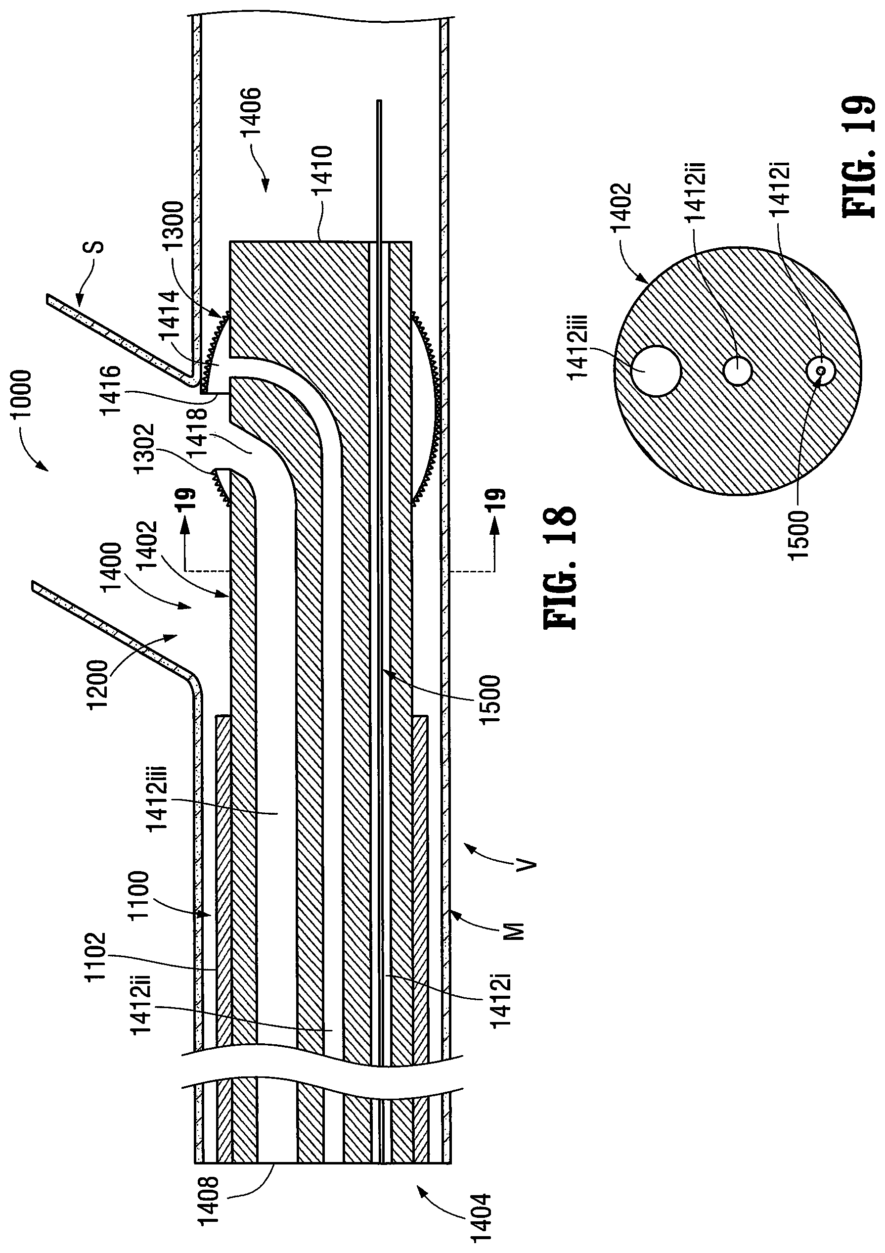 Patent US12303412 Figure 12 – Orientable implantable device and method