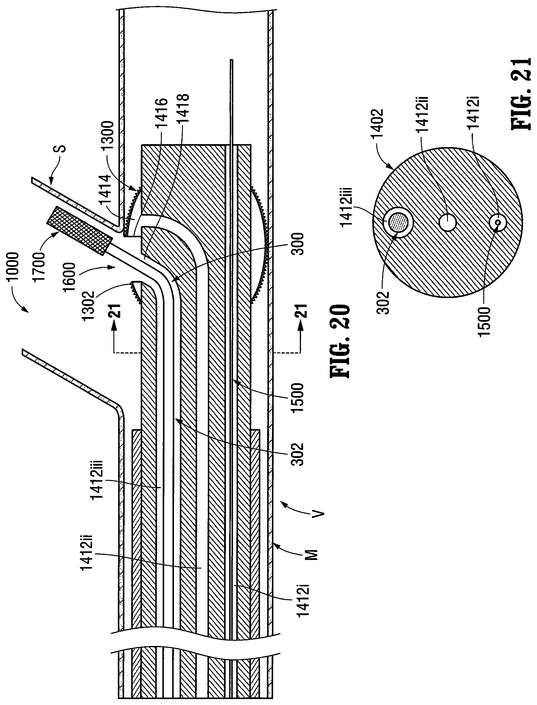 Patent US12303412 Figure 13 – Orientable implantable device and method