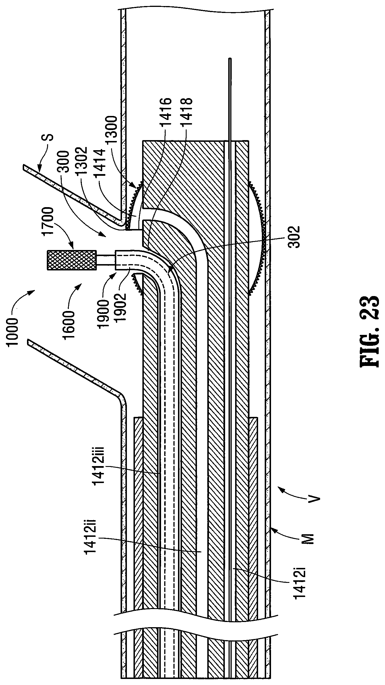 Patent US12303412 Figure 15 – Orientable implantable device and method
