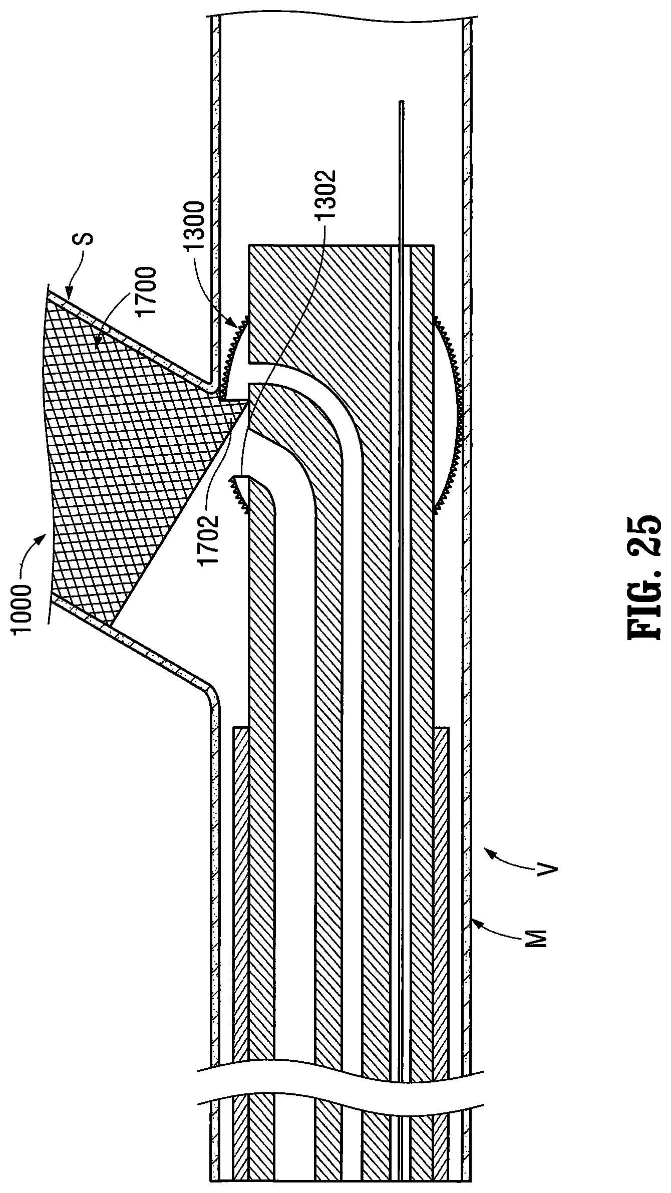 Patent US12303412 Figure 17 – Orientable implantable device and method
