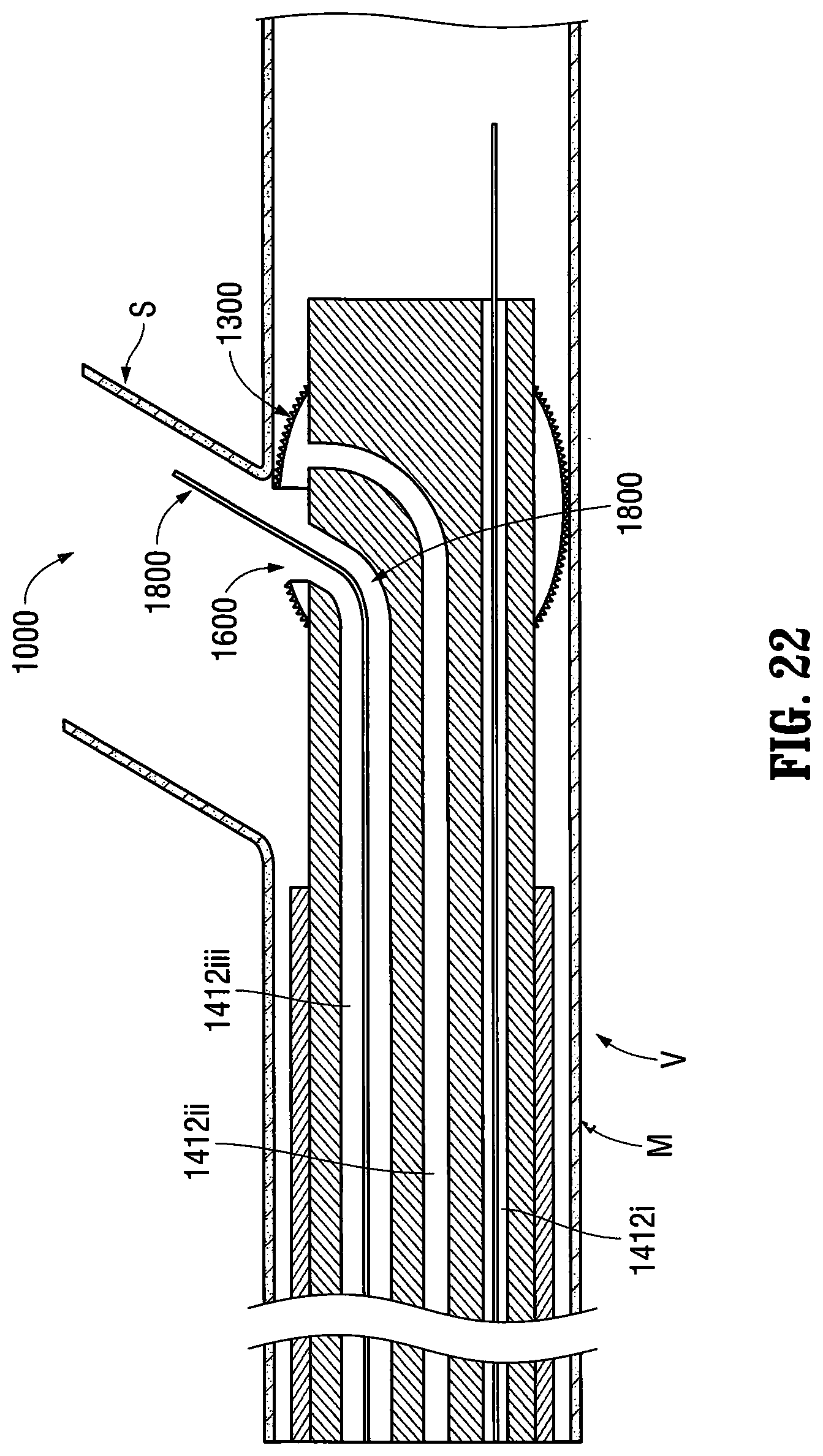 Patent US12303413 Figure 14 – Orientable implantable device and method