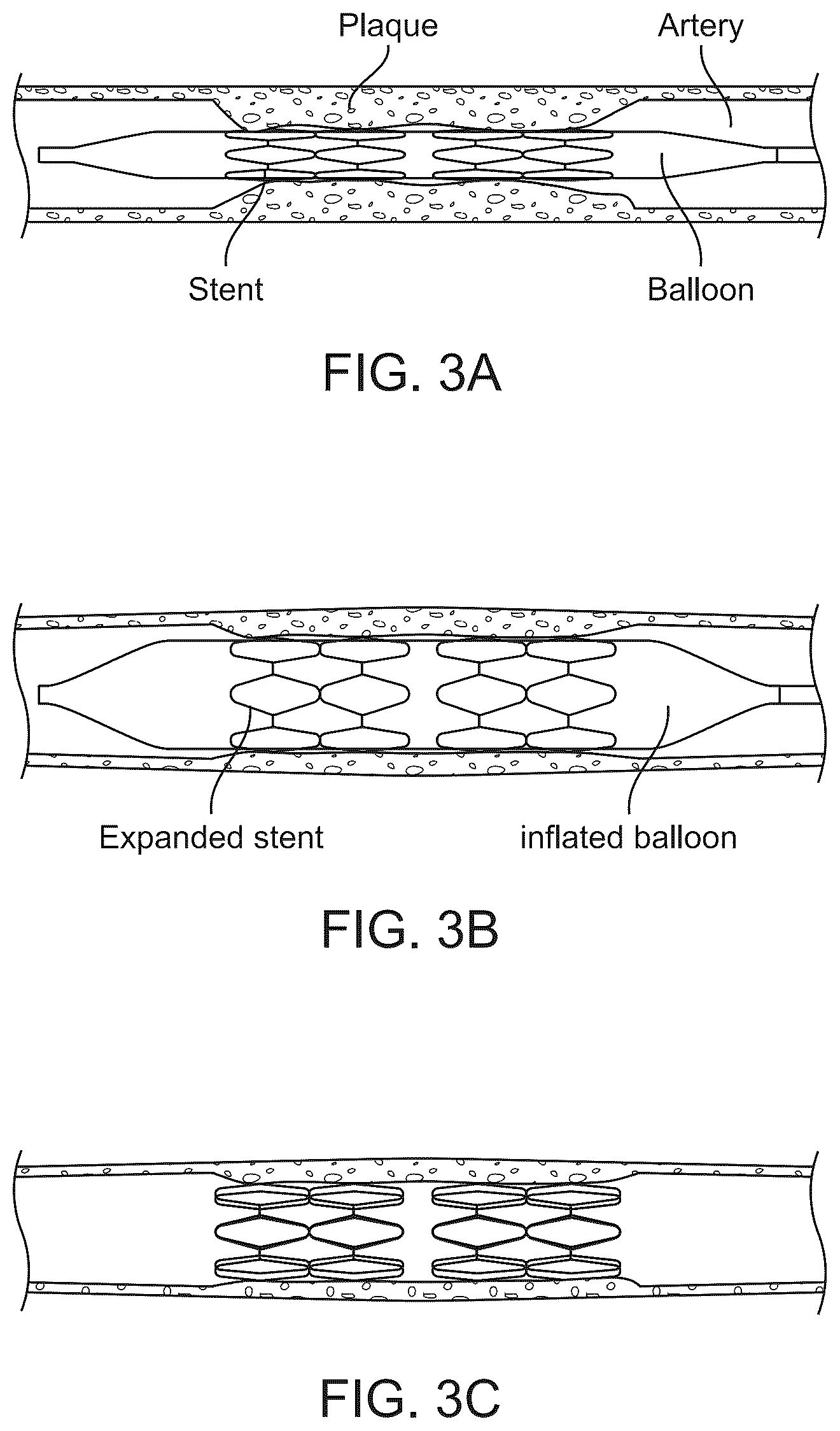 Patent US12303414 Figure 3 – Absorbable intravascular devices that shorten upon expansion creating space for vascular movement