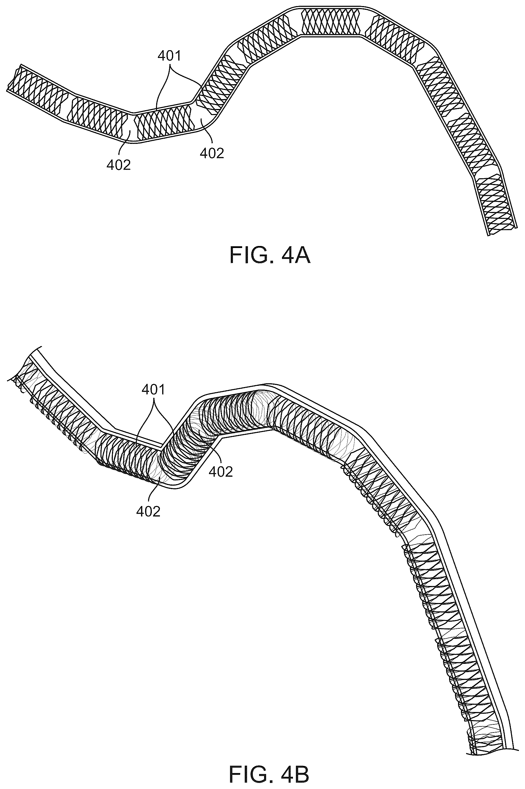 Patent US12303414 Figure 4 – Absorbable intravascular devices that shorten upon expansion creating space for vascular movement