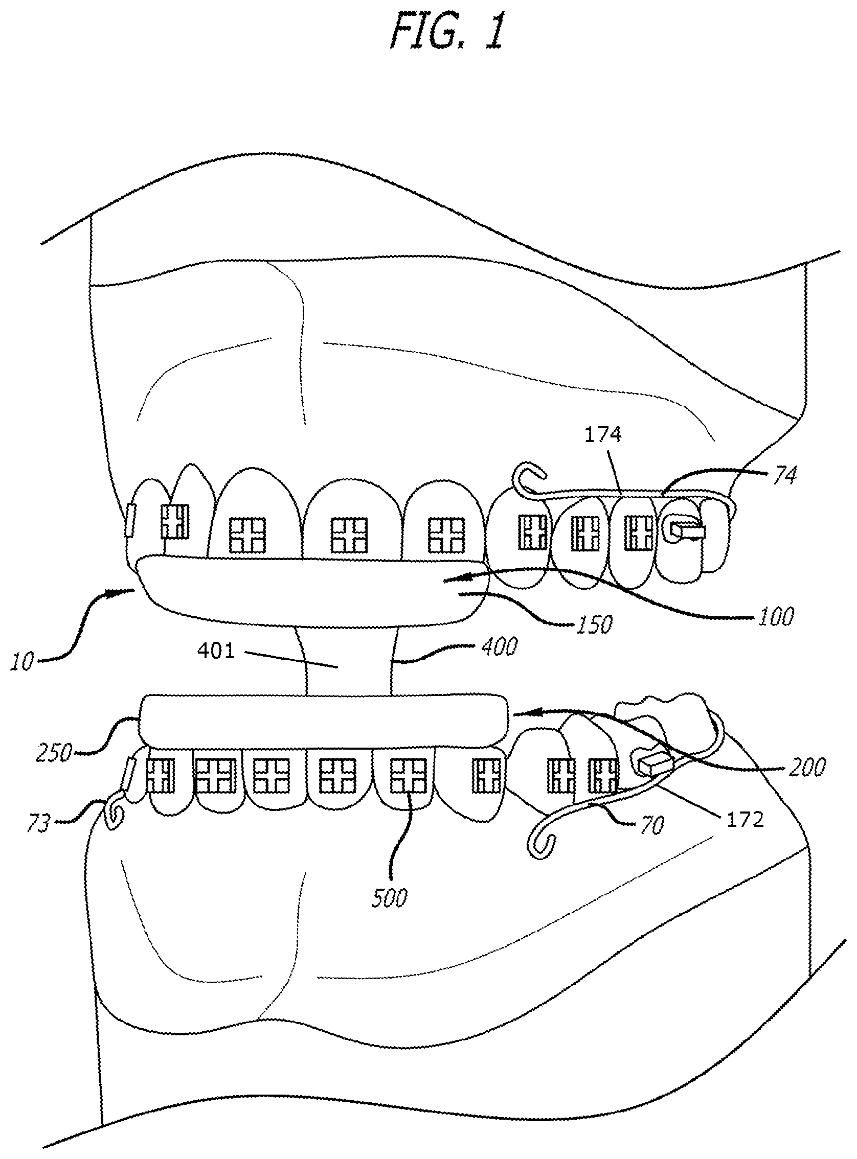 Patent US12303424 Figure 1 – Adjustable sleep apnea oral appliance for use with orthodontic braces
