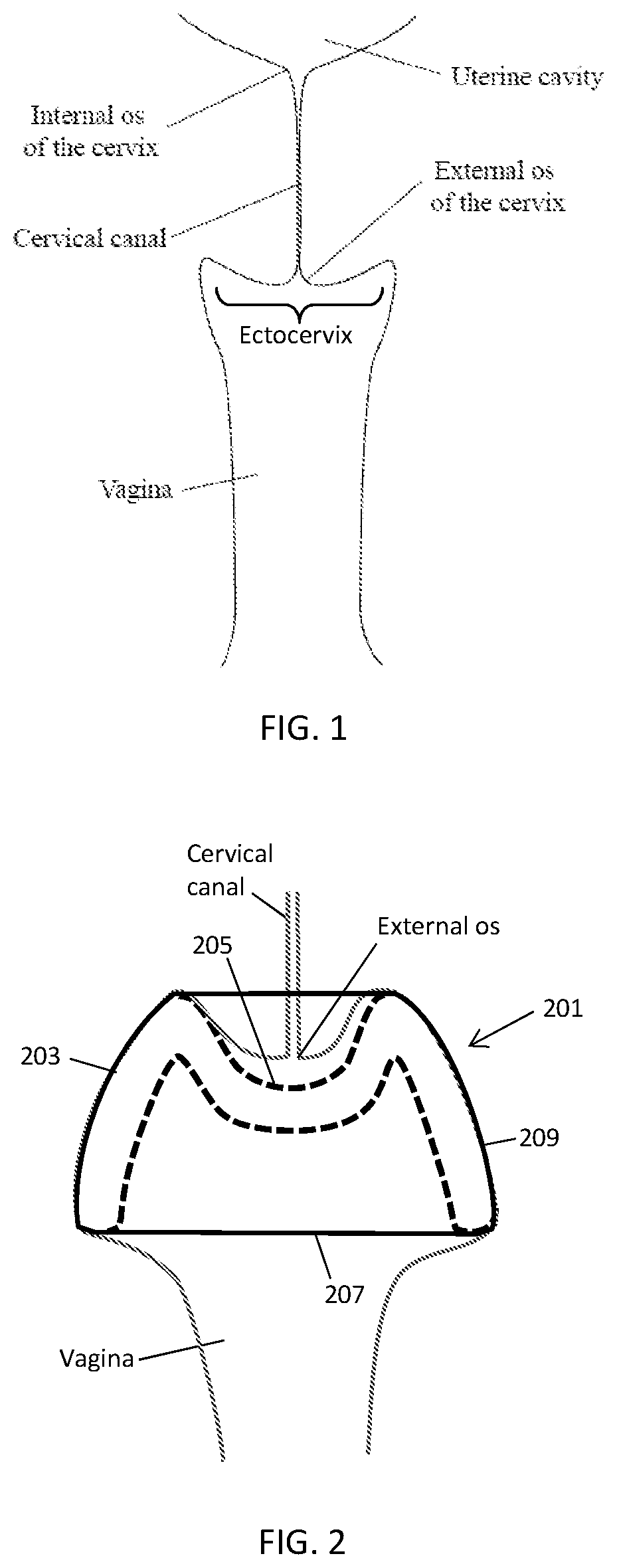Patent US12303425 Figure 1 – Methods and devices to prevent premature birth, stillbirth, miscarriage, infection, or pregnancy