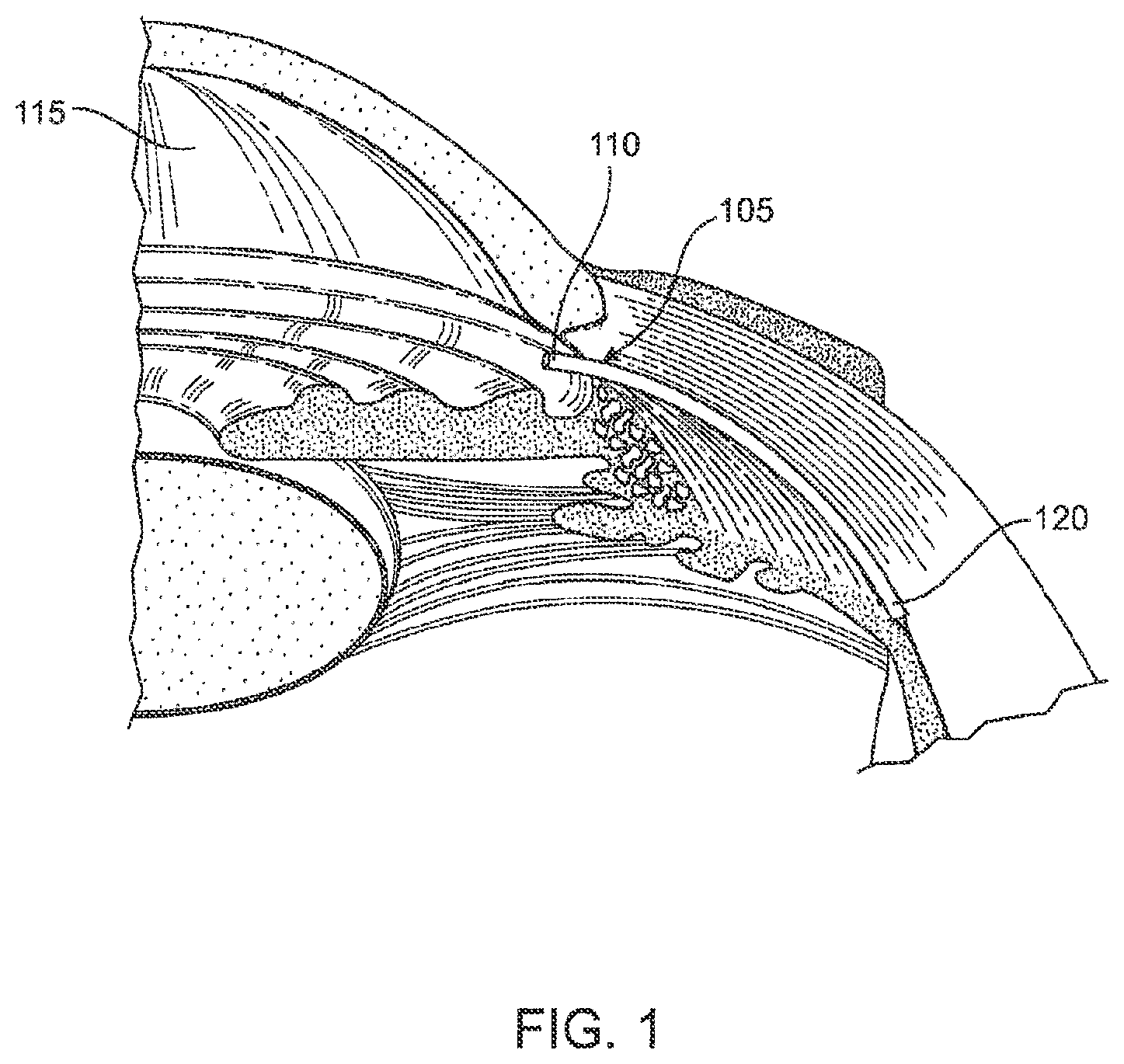 Patent US12303430 Figure 1 – Glaucoma treatment device
