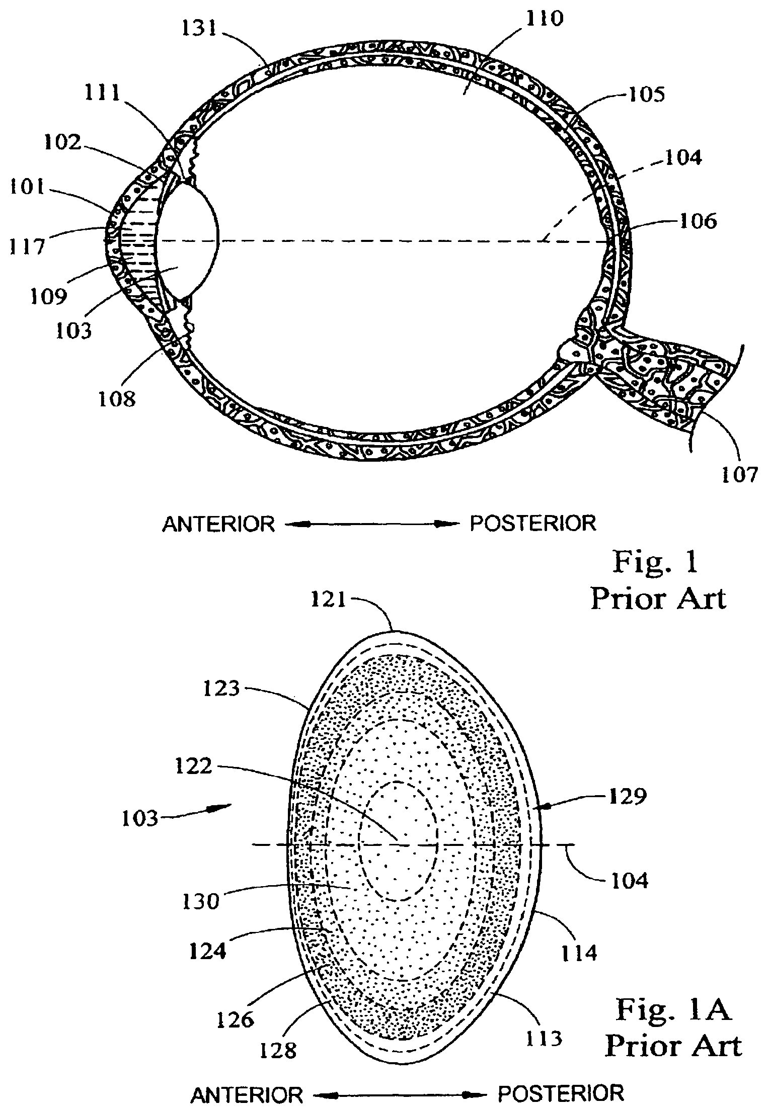 Patent US12303431 — System and apparatus for treating the lens of an eye — Figure 1