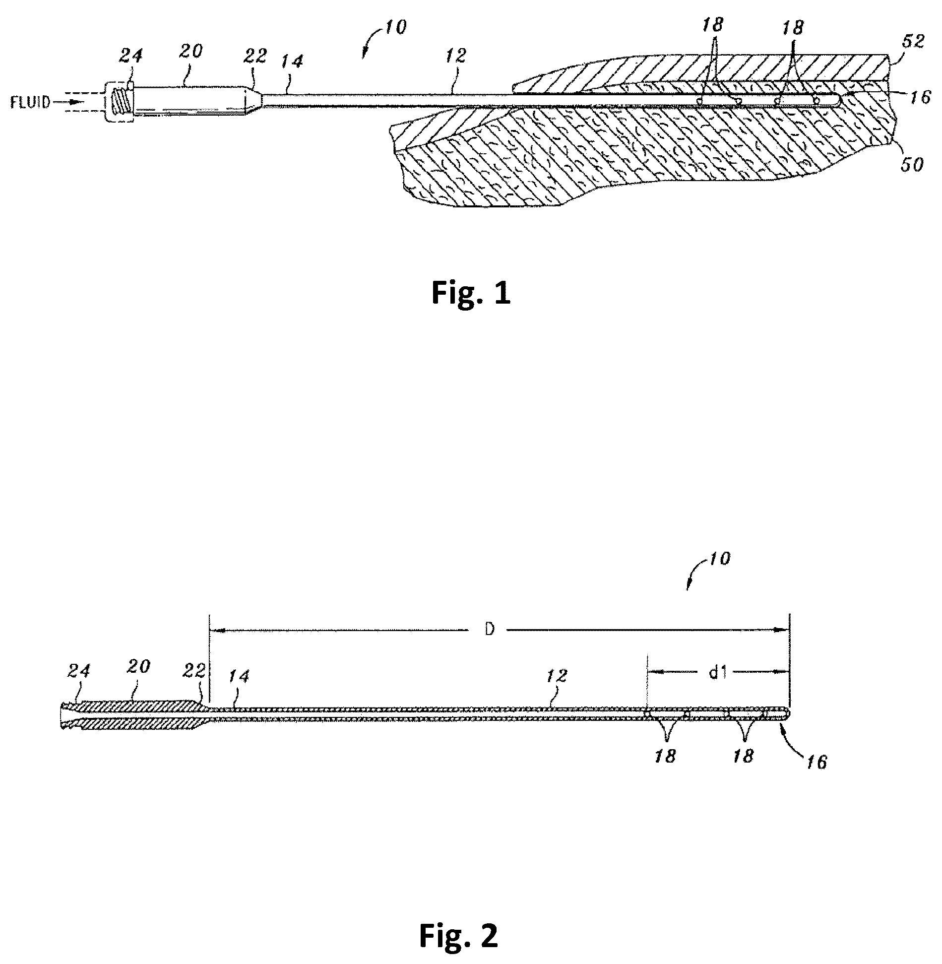 Patent US12303591 — Tumescent infiltration drug delivery of high subcutaneous drug concentrations with prolonged local and systemic effects and minimal local or systemic toxicity — Figure 1