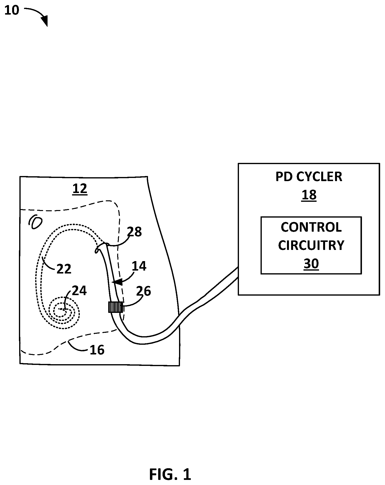 Patent US12303627 — Peritoneal dialysis system — Figure 1