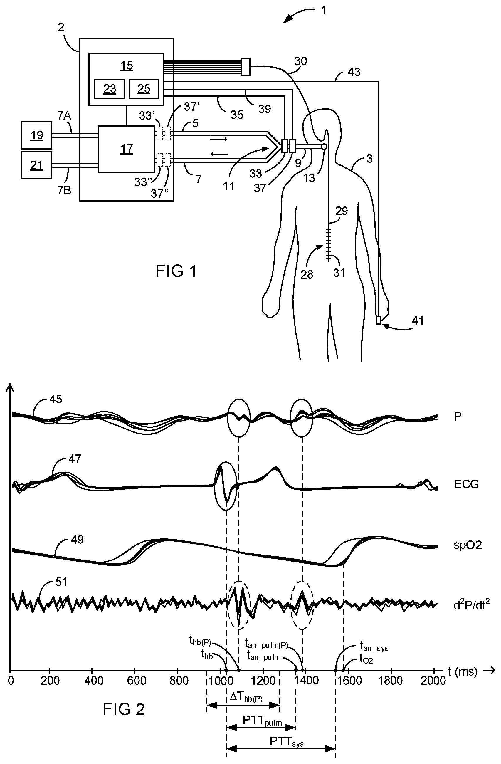 Patent US12303642 Figure 1 – Non-invasive estimation of hemodynamic parameters during mechanical ventilation