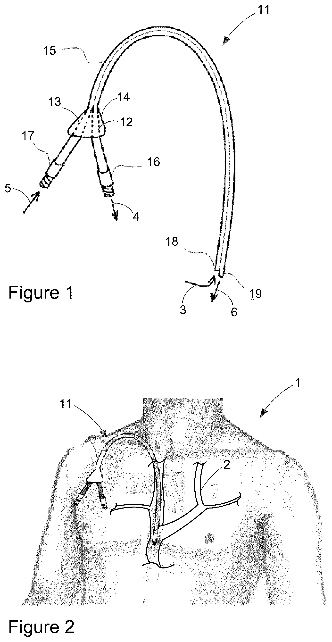 Patent US12303649 — Catheter clearance device and method of use — Figure 1