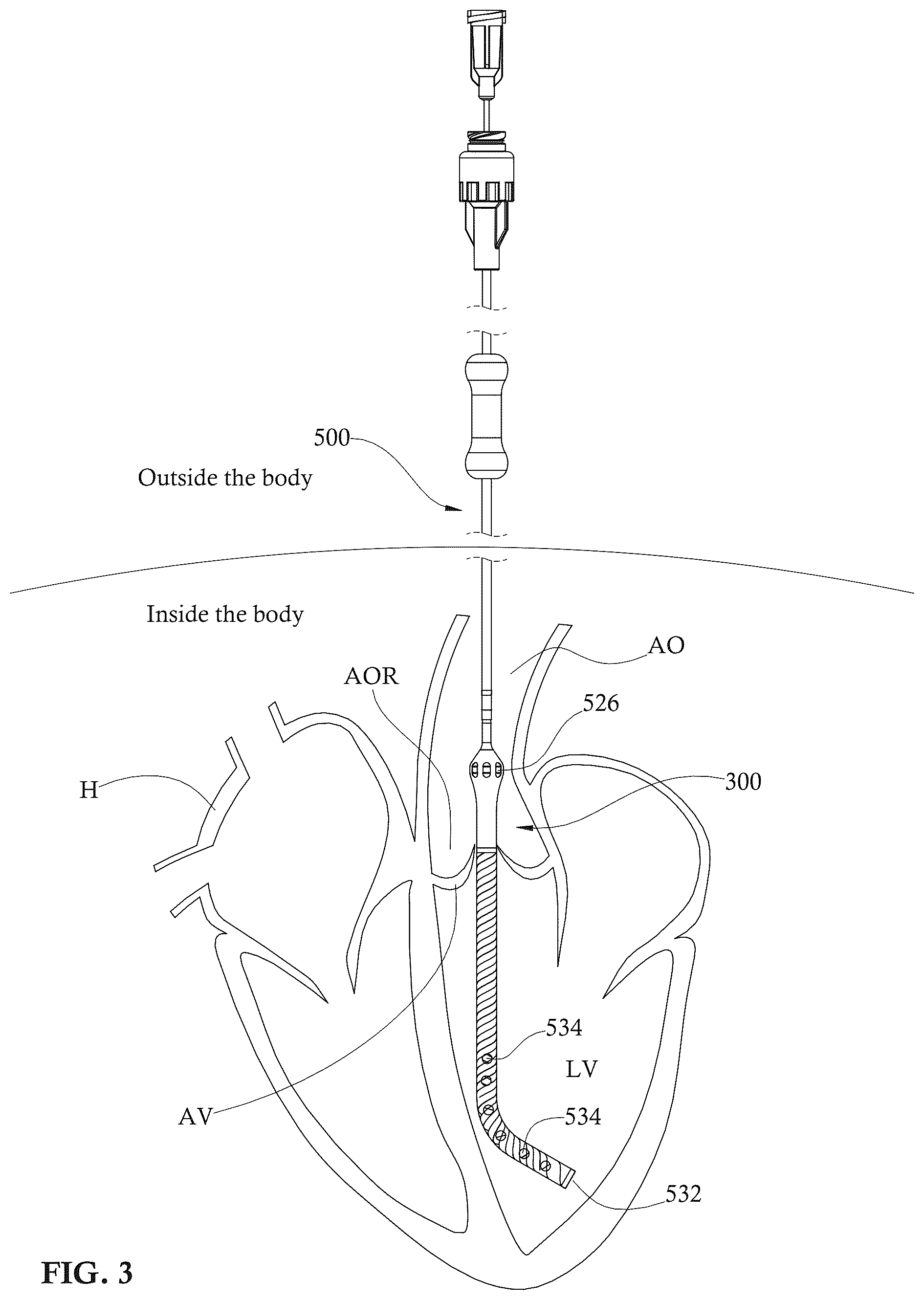 Patent US12303679 Figure 3 – Expandable mechanical hemodynamic support systems, devices, and methods
