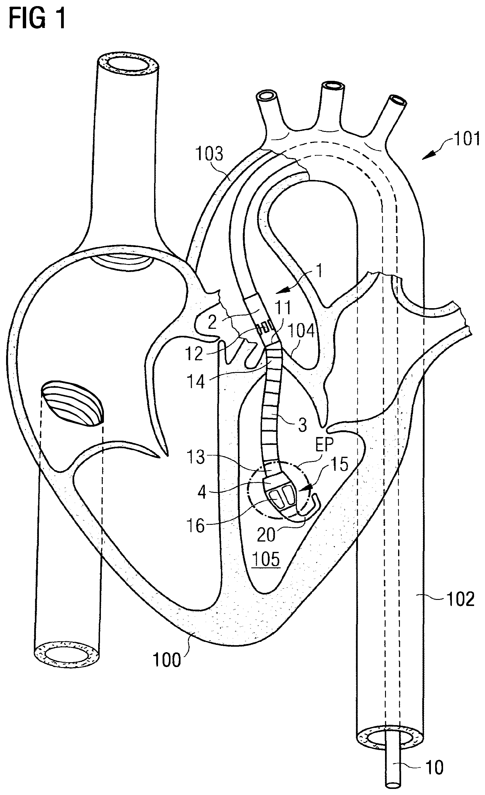 Patent US12303680 — Blood pump — Figure 1