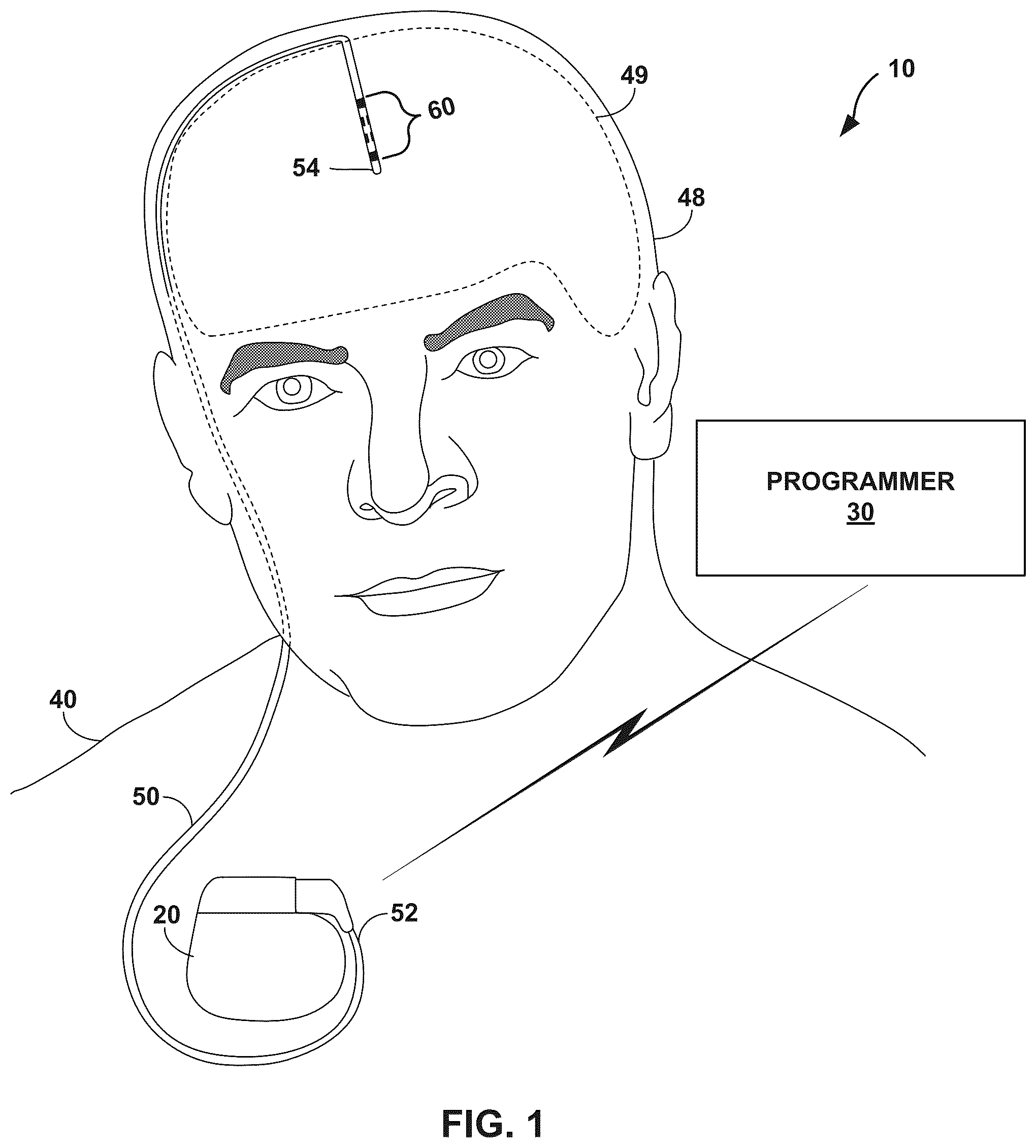 Patent US12303682 Figure 1 – Medical lead with segmented electrodes