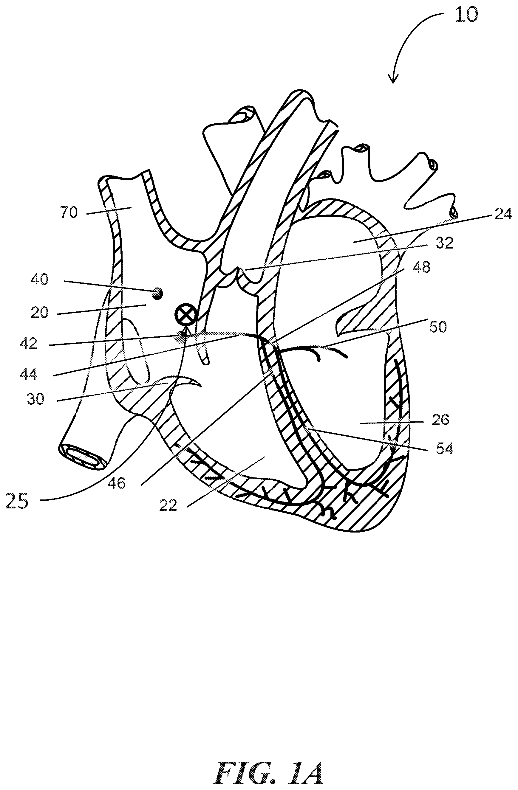 Patent US12303684 — Transcoronary sinus pacing of posteroseptal left ventricular base — Figure 1