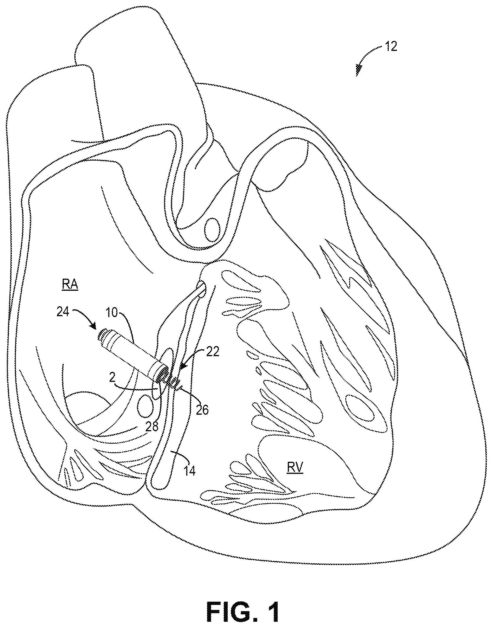Patent US12303685 — Electrode configuration for a medical device — Figure 1