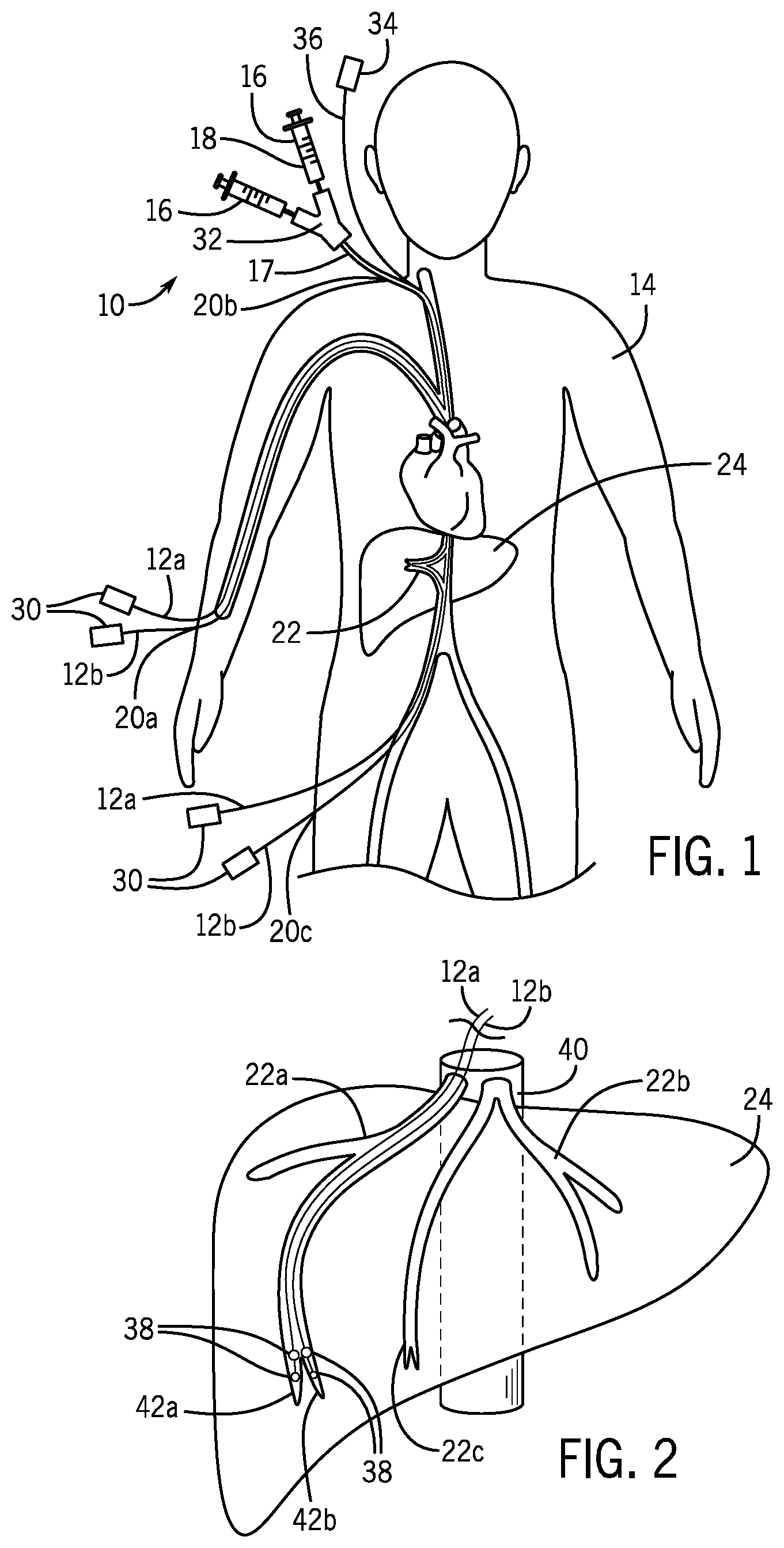 Patent US12303687 — In vivo gene therapy delivery procedure and device — Figure 1