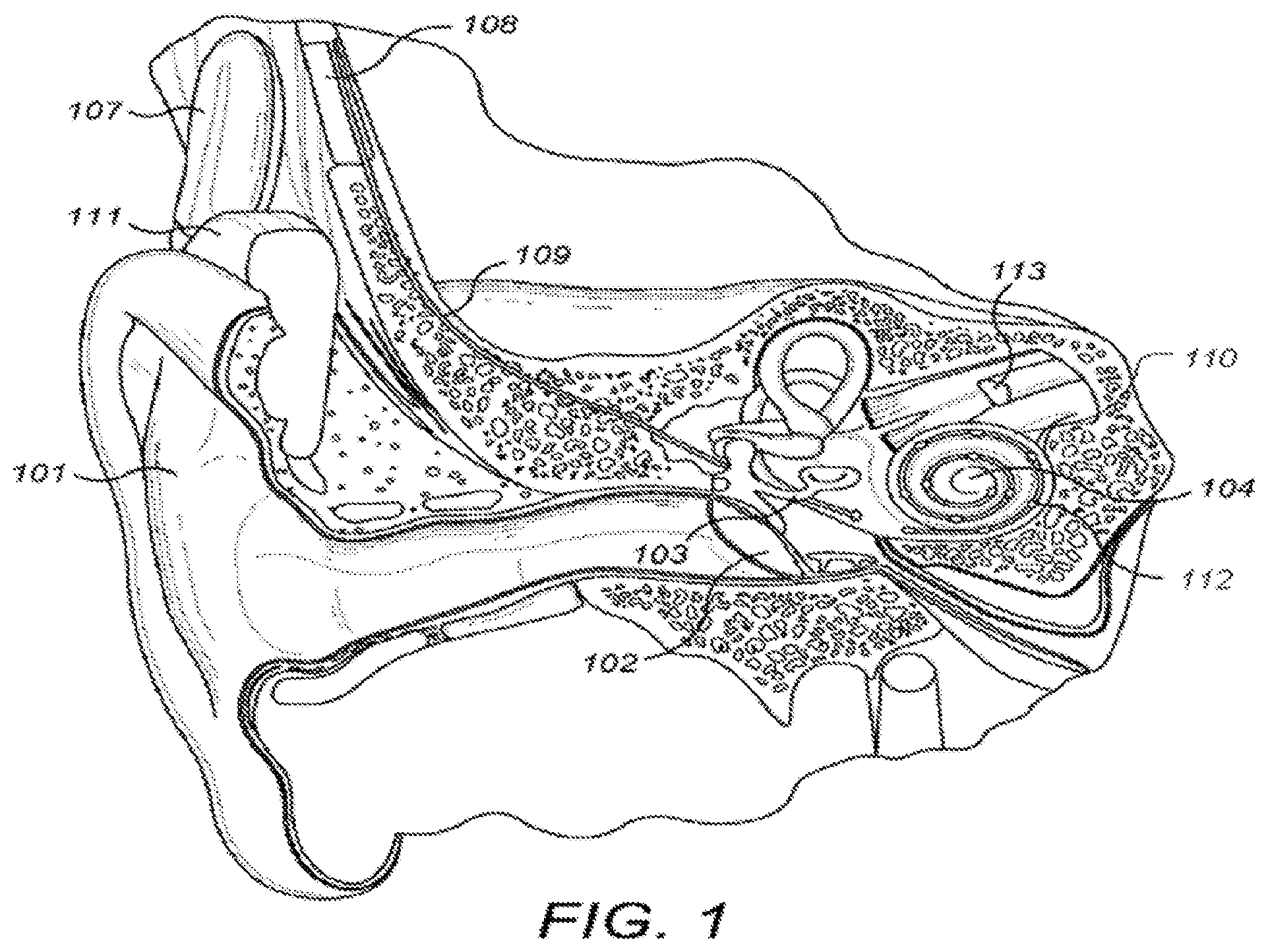 Patent US12303689 — Polyphonic pitch enhancement in a cochlear implant — Figure 1