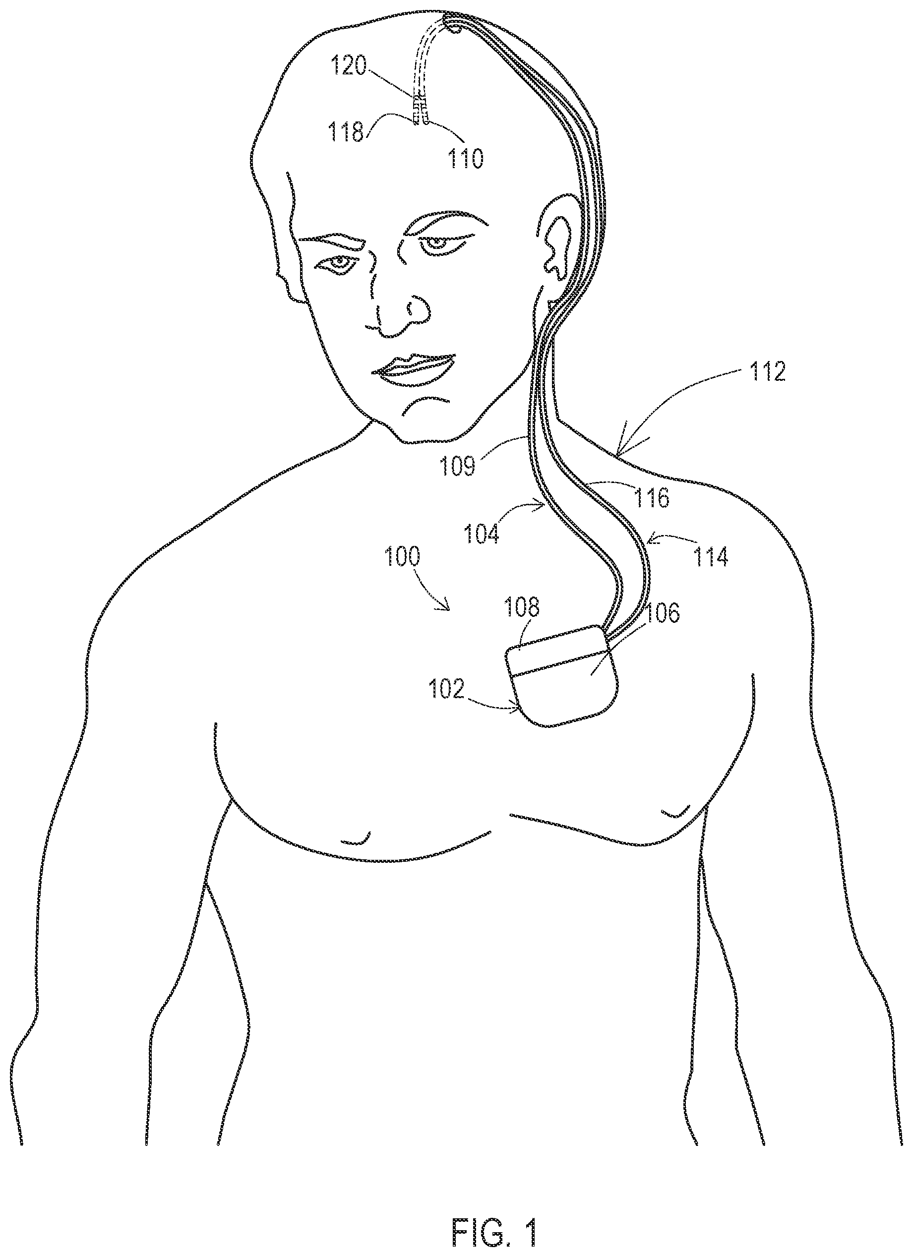 Patent US12303692 Figure 1 – Devices and methods for sensing physiological signals during stimulation therapy