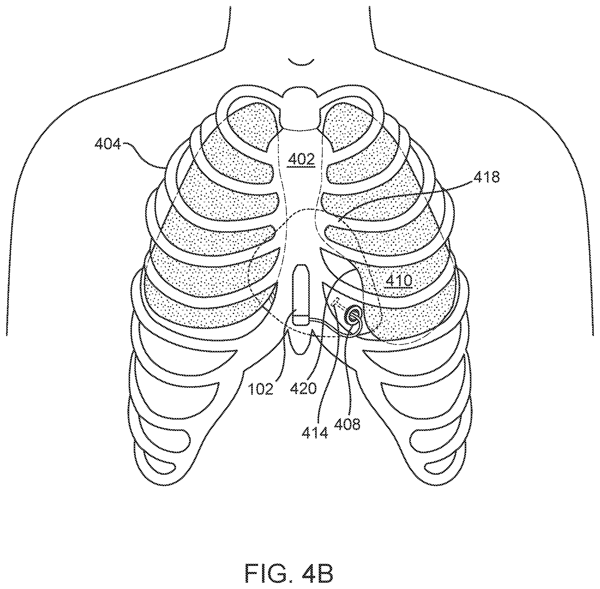 Patent US12303696 Figure 5 – Cardiac pacing sensing and control