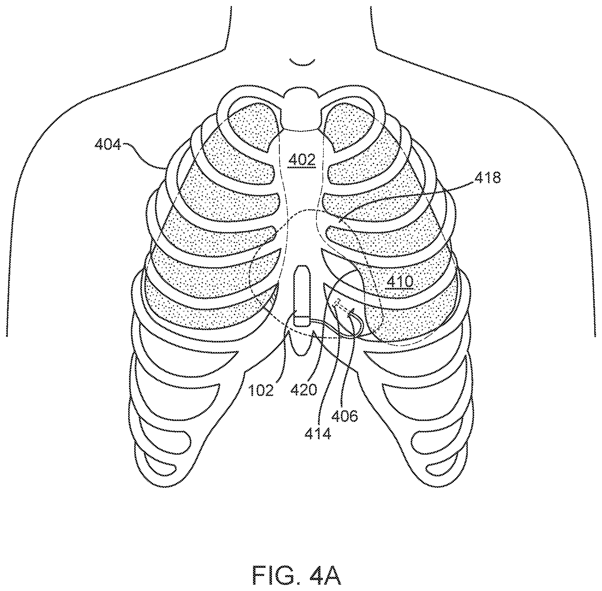Patent US12303697 Figure 4 – Cardiac pacing sensing and control